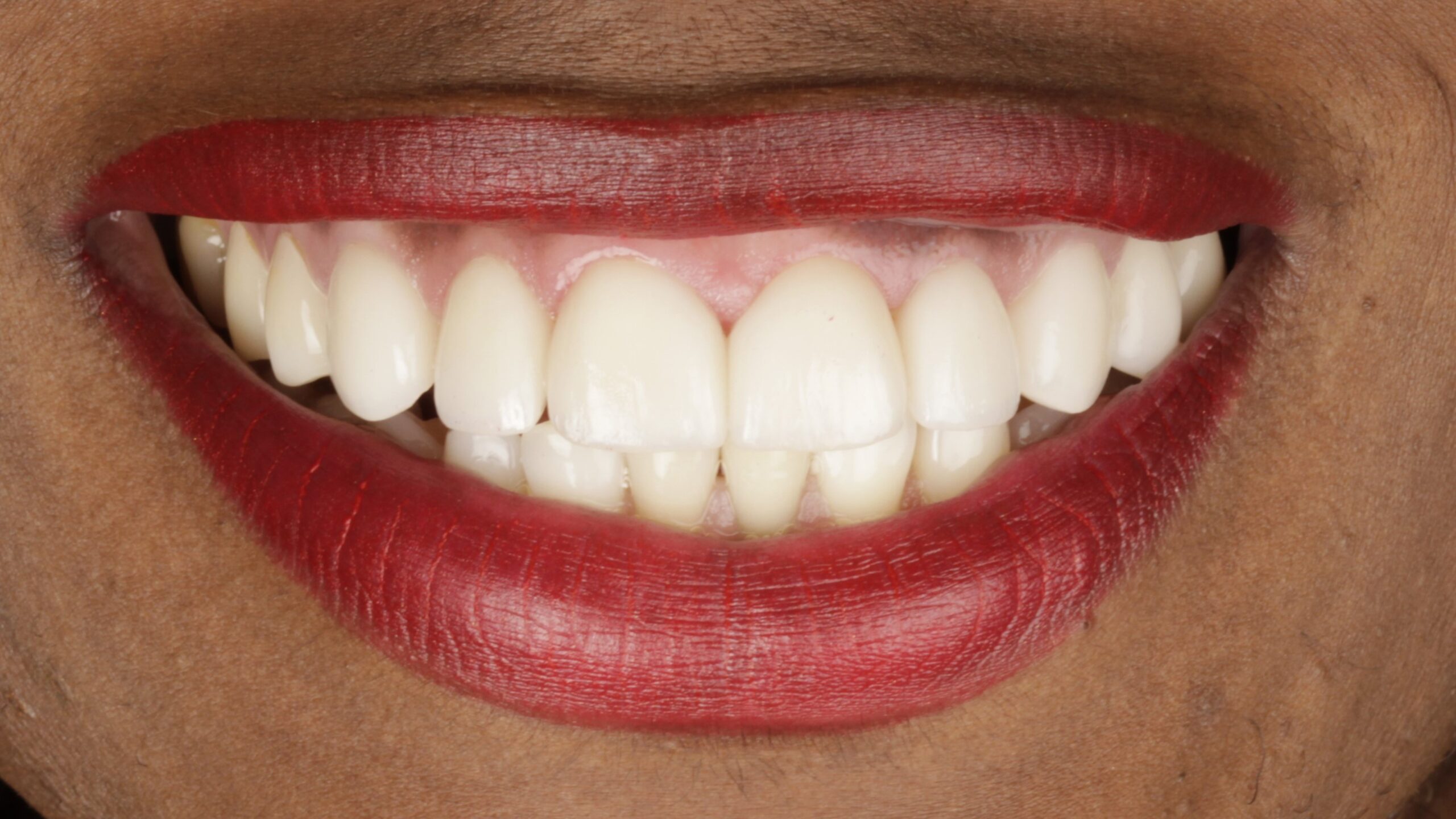 A completed porcelain veneer case