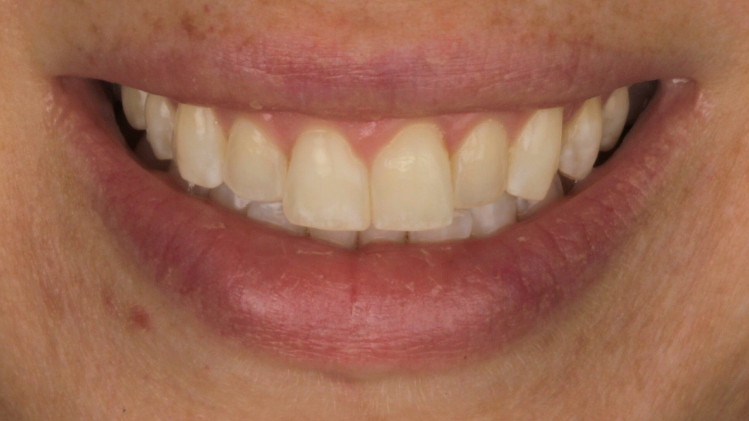 Before: gapped and worn teeth