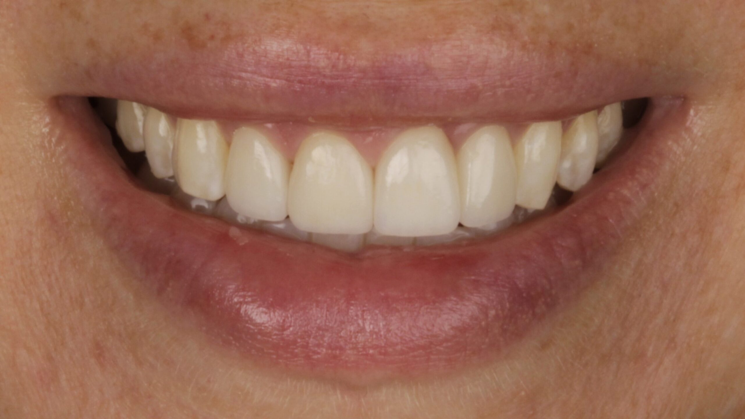 After: porcelain veneers