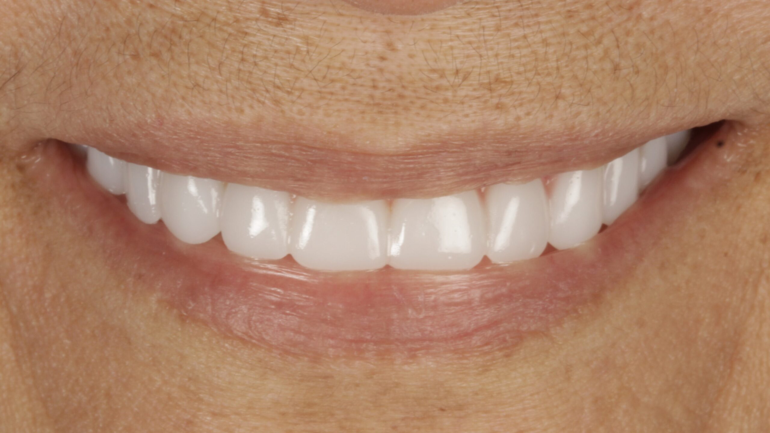 After: both arches restored on implants