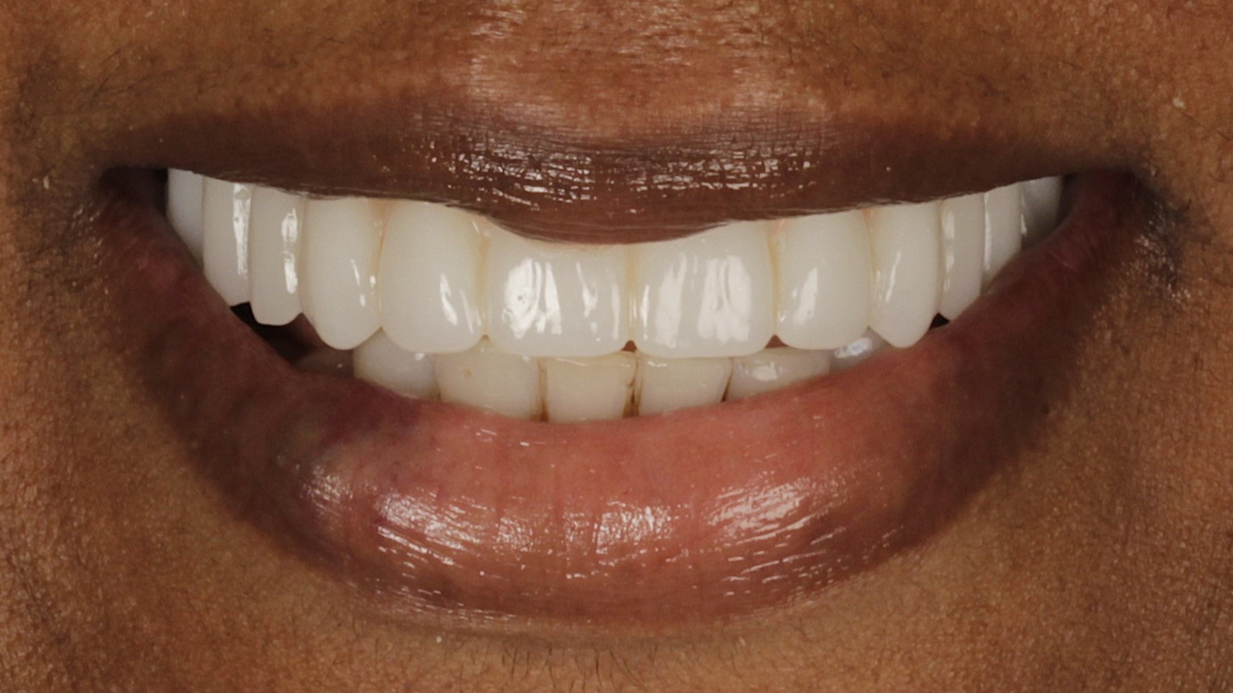 After: upper arch restored on four implants