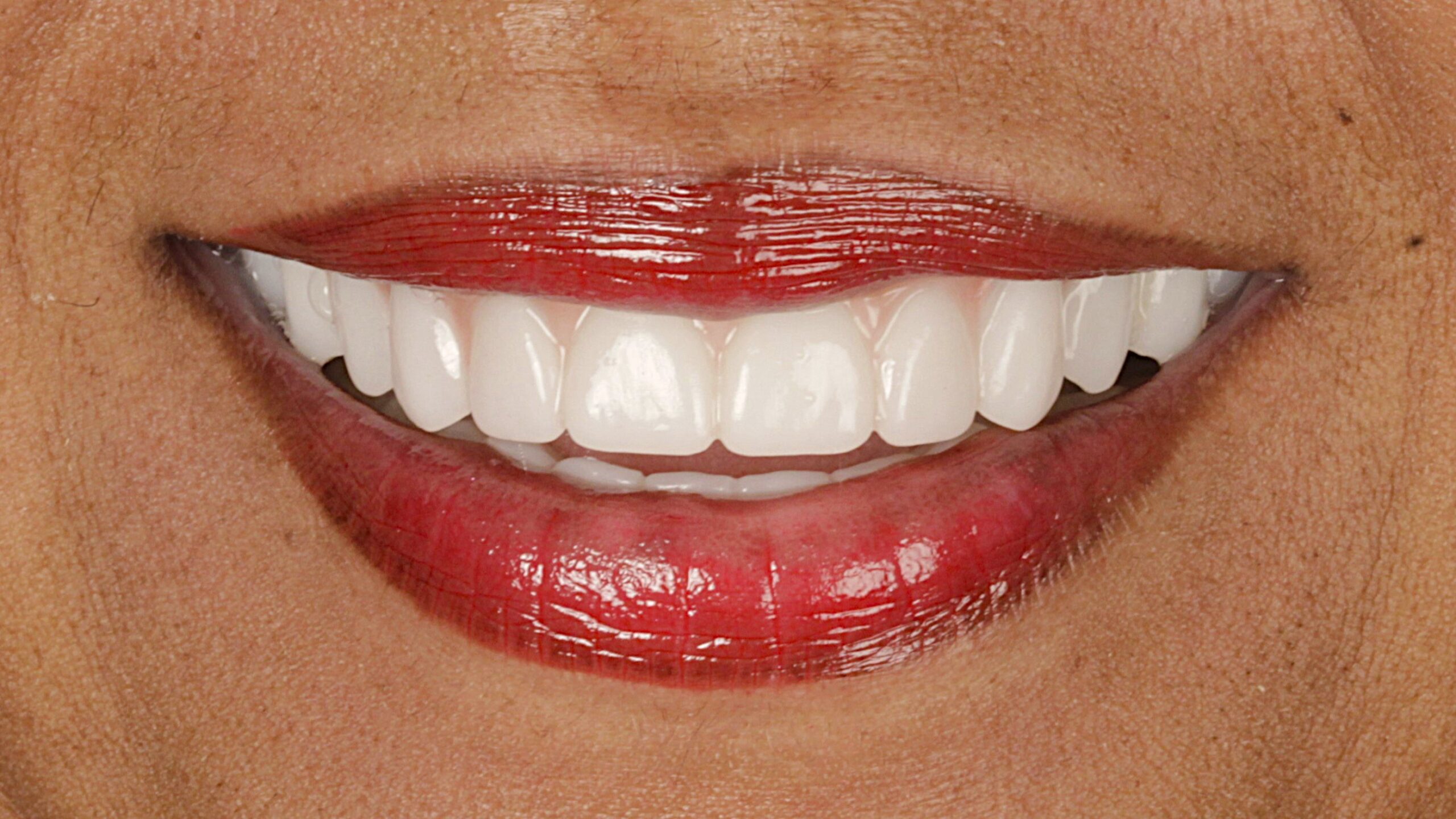 After: fixed full-arch restoration