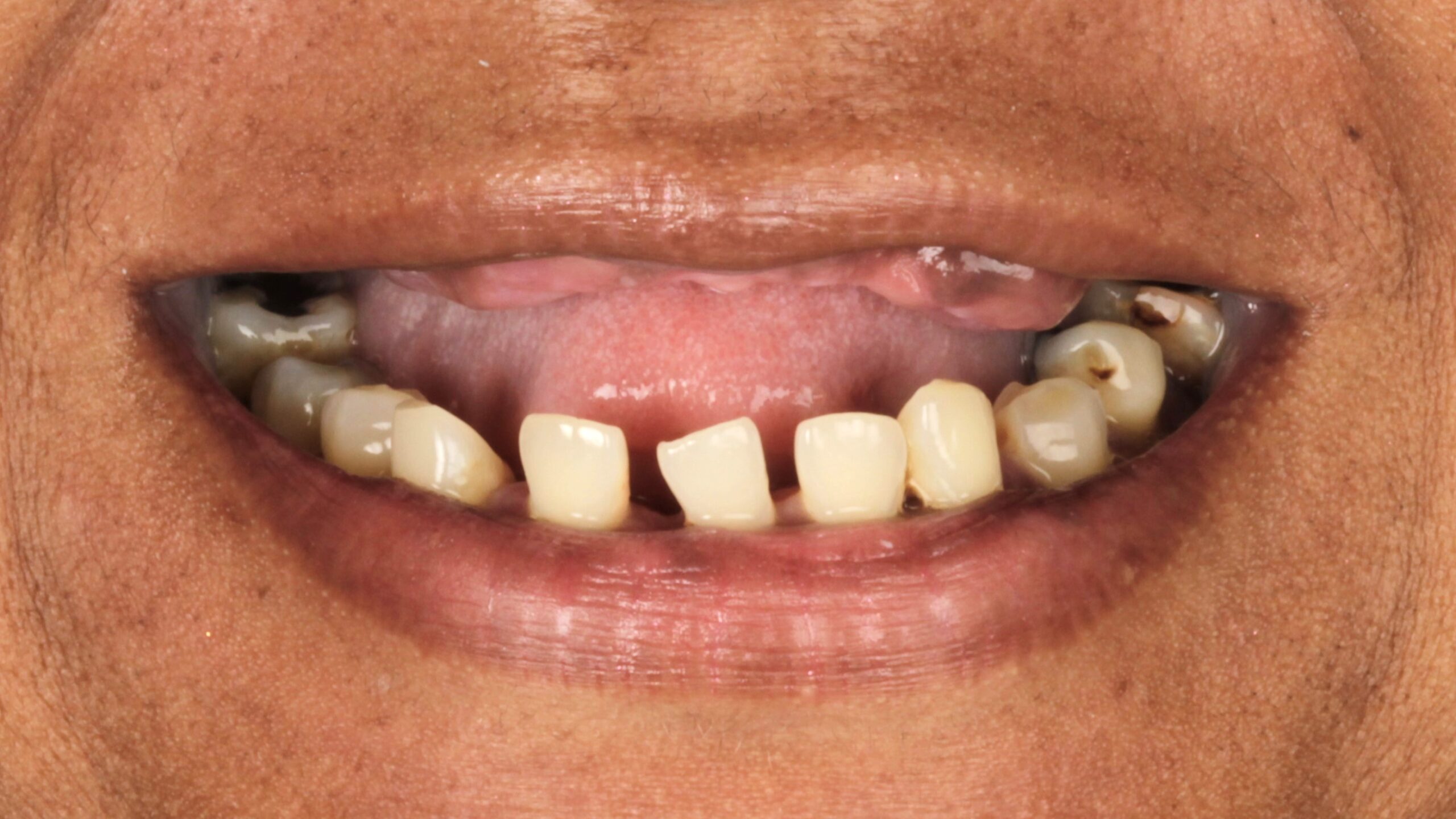 Before: failing upper and lower dentition