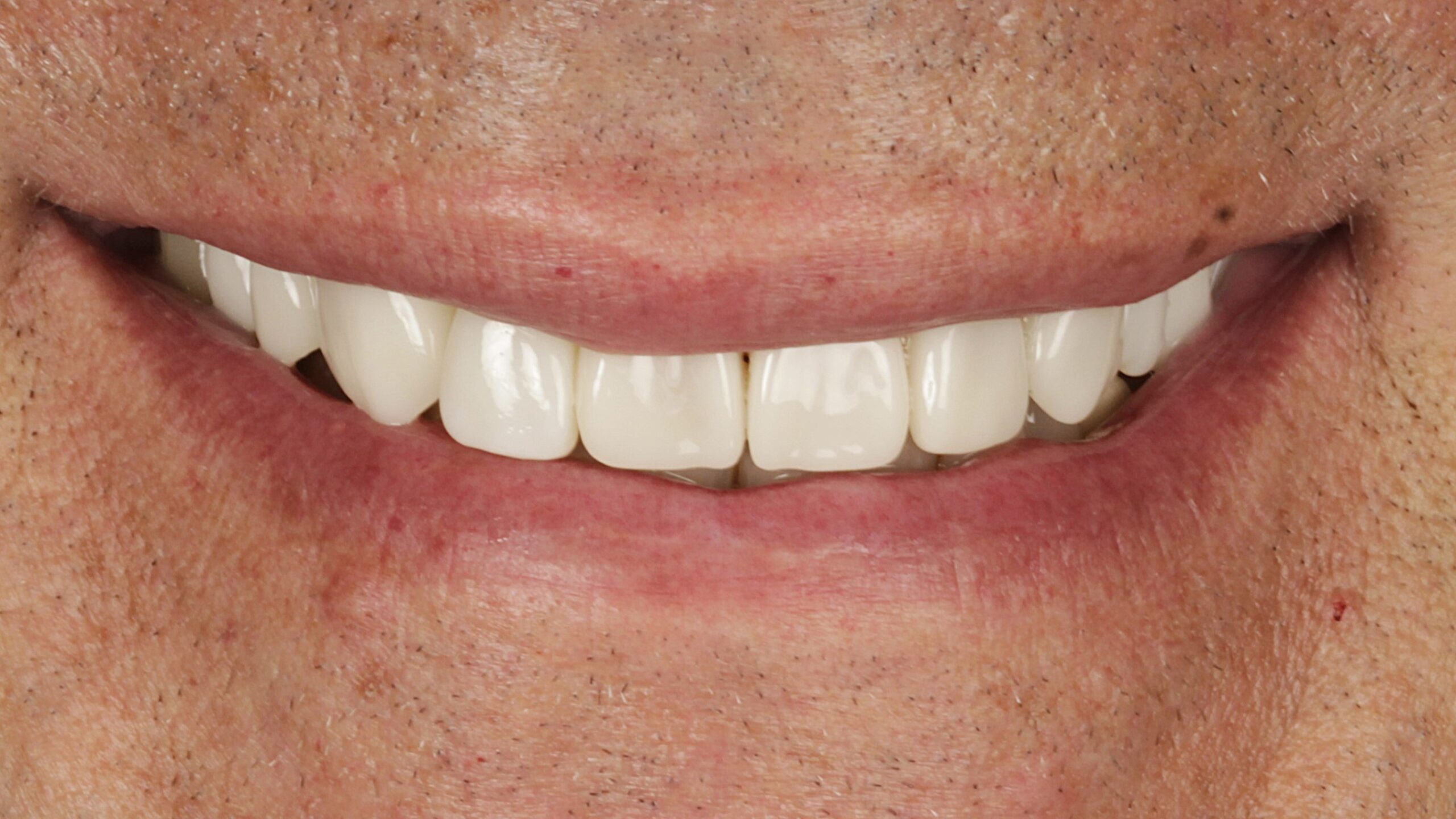 After: veneers + implants case 1