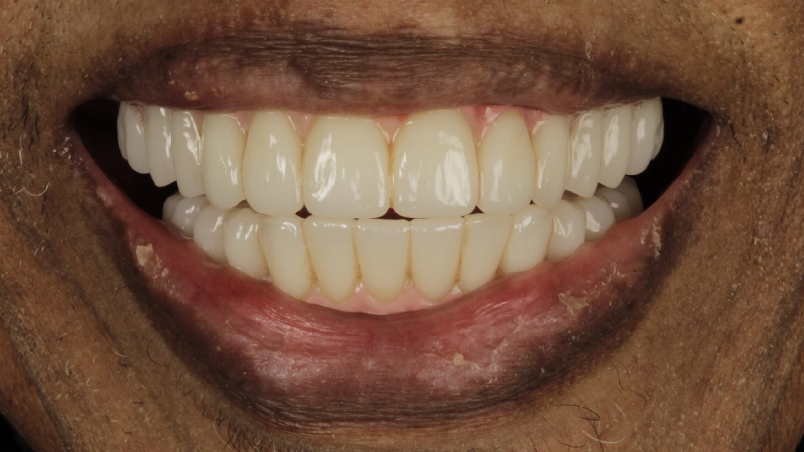 After: double arch case 3