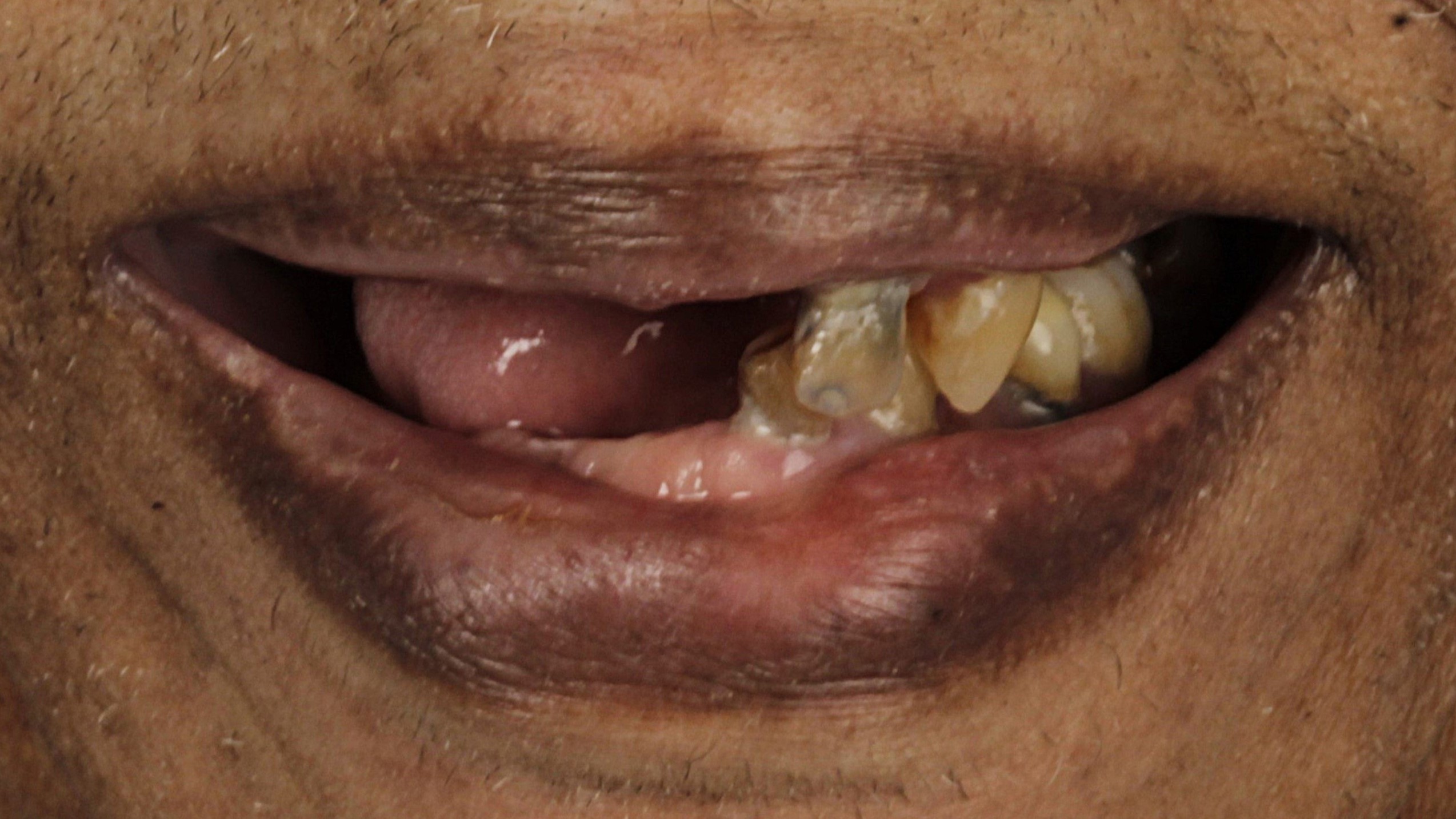 Before: double arch case 3