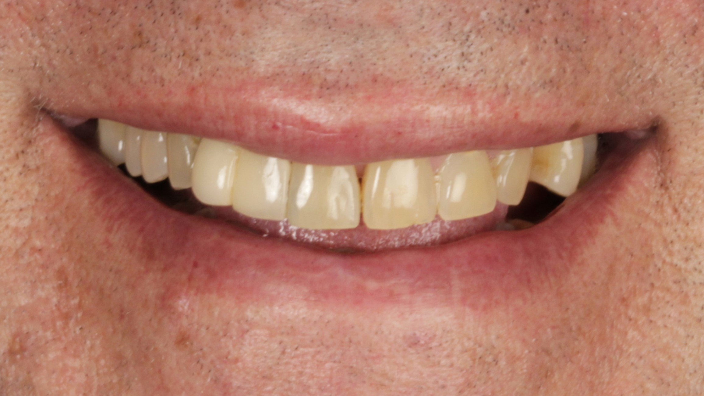 Before: veneers + implants case 1