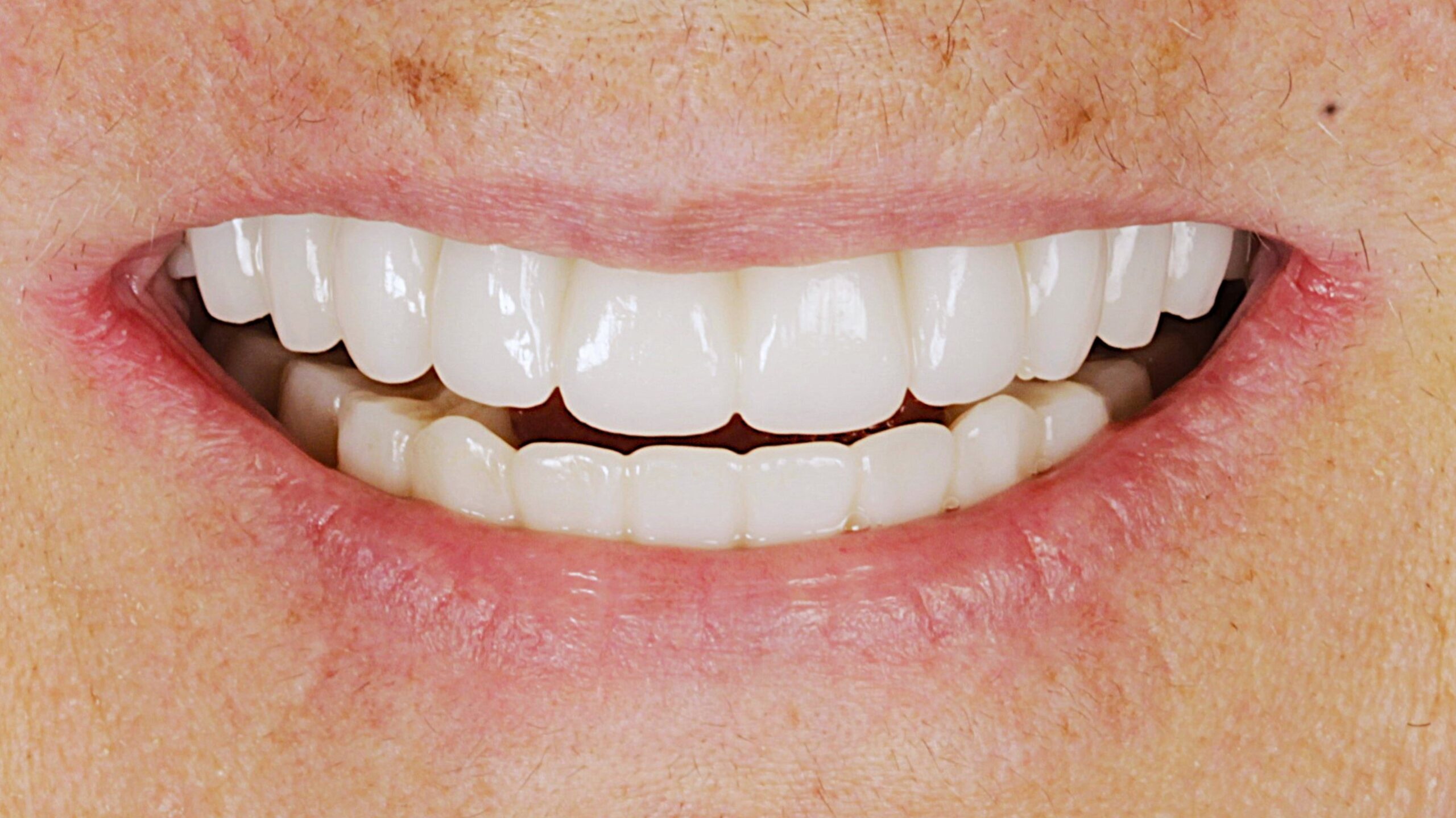 After: double arch case 11