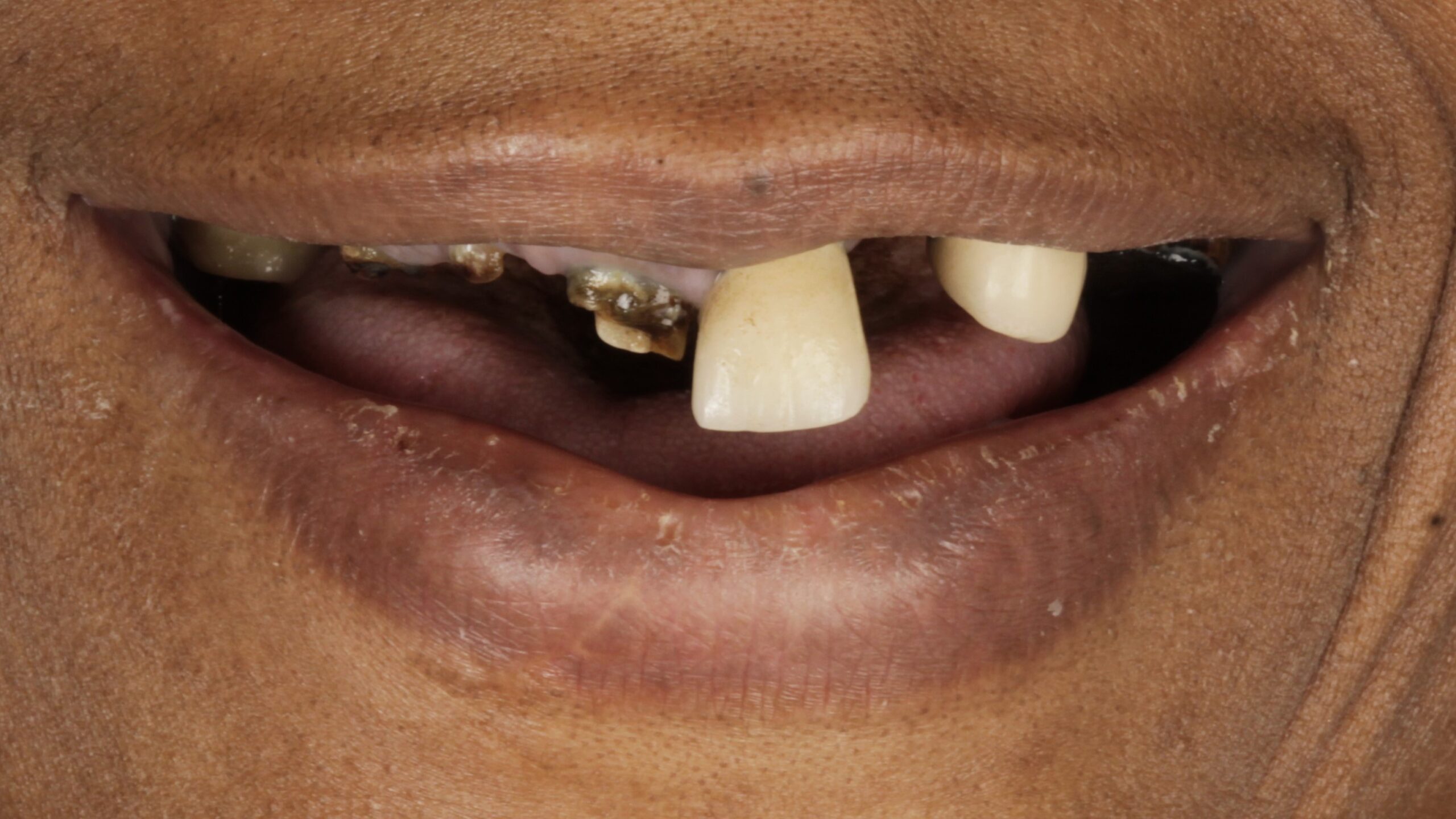 Before: double arch case 12