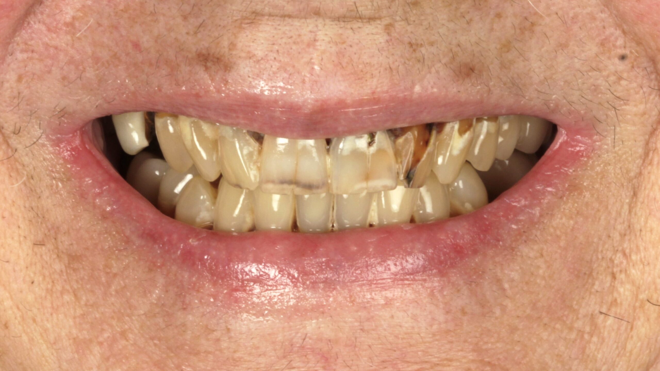 Before: double arch case 11