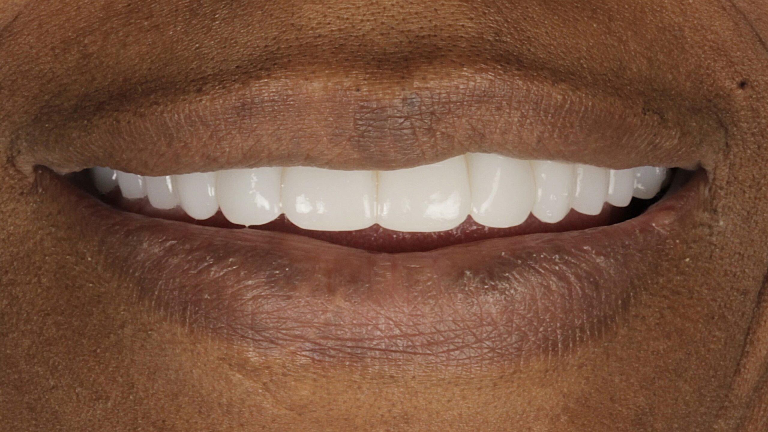 After: double arch case 12
