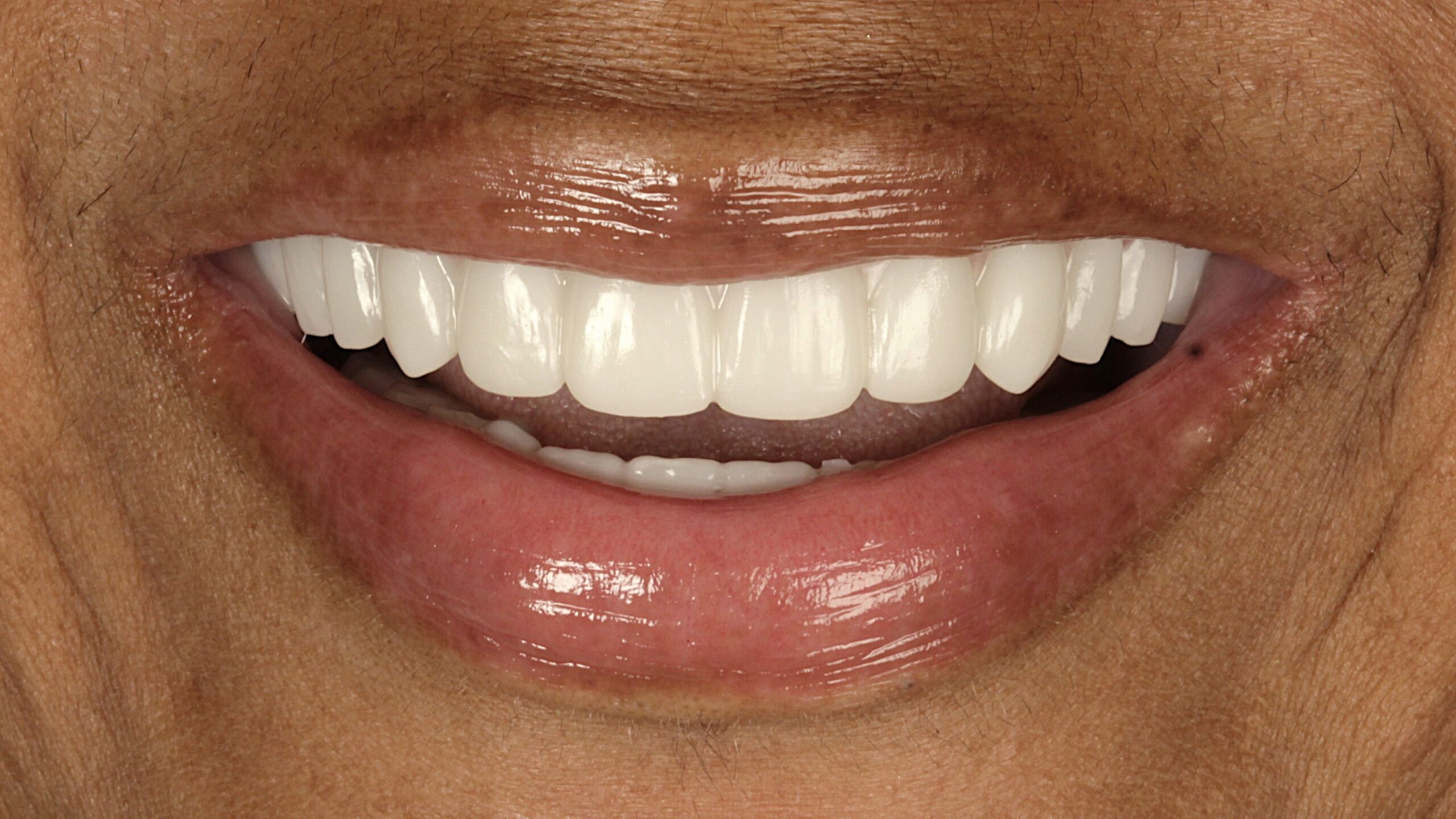 After: double arch case 13