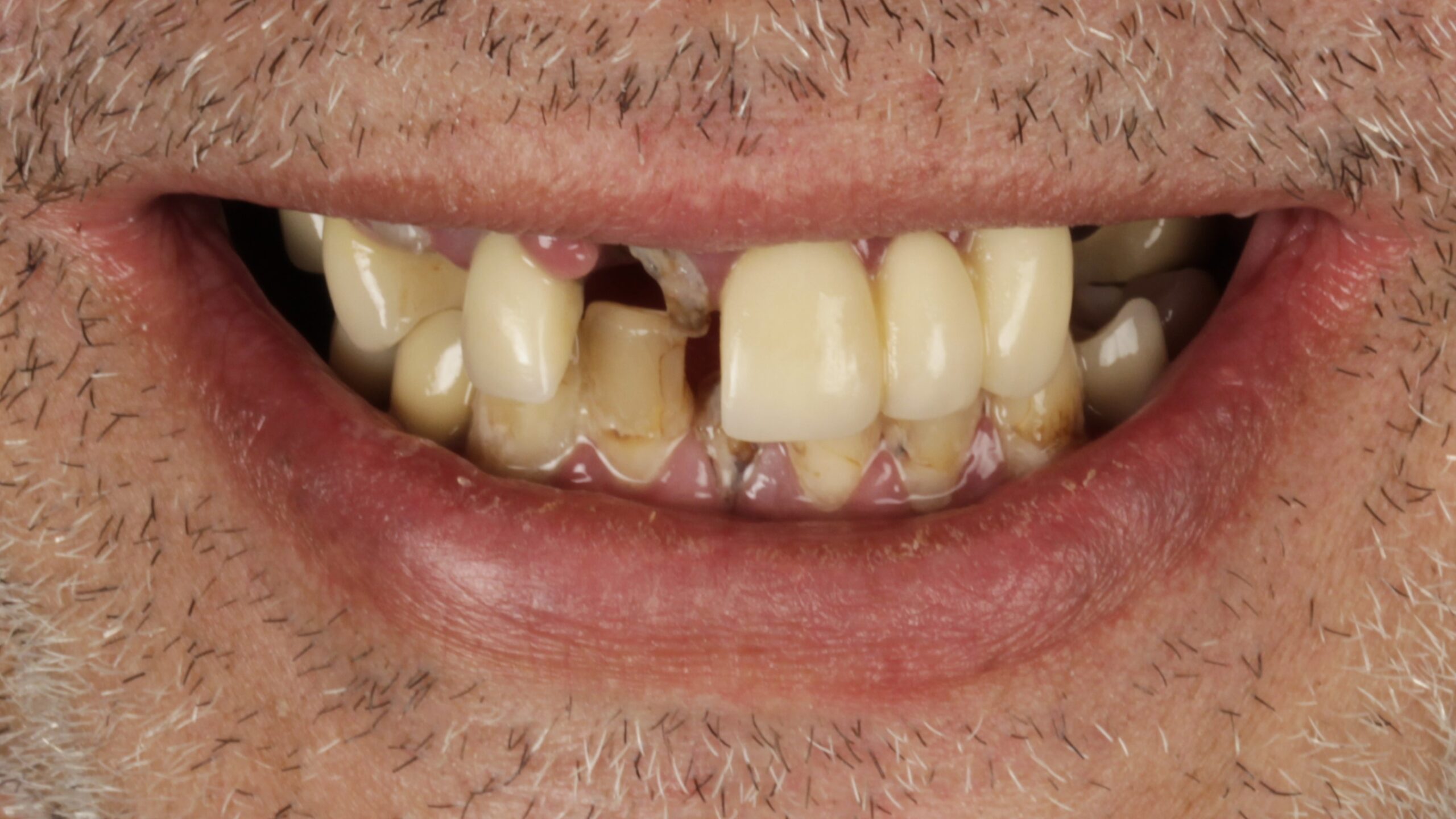 Before: double arch case 14