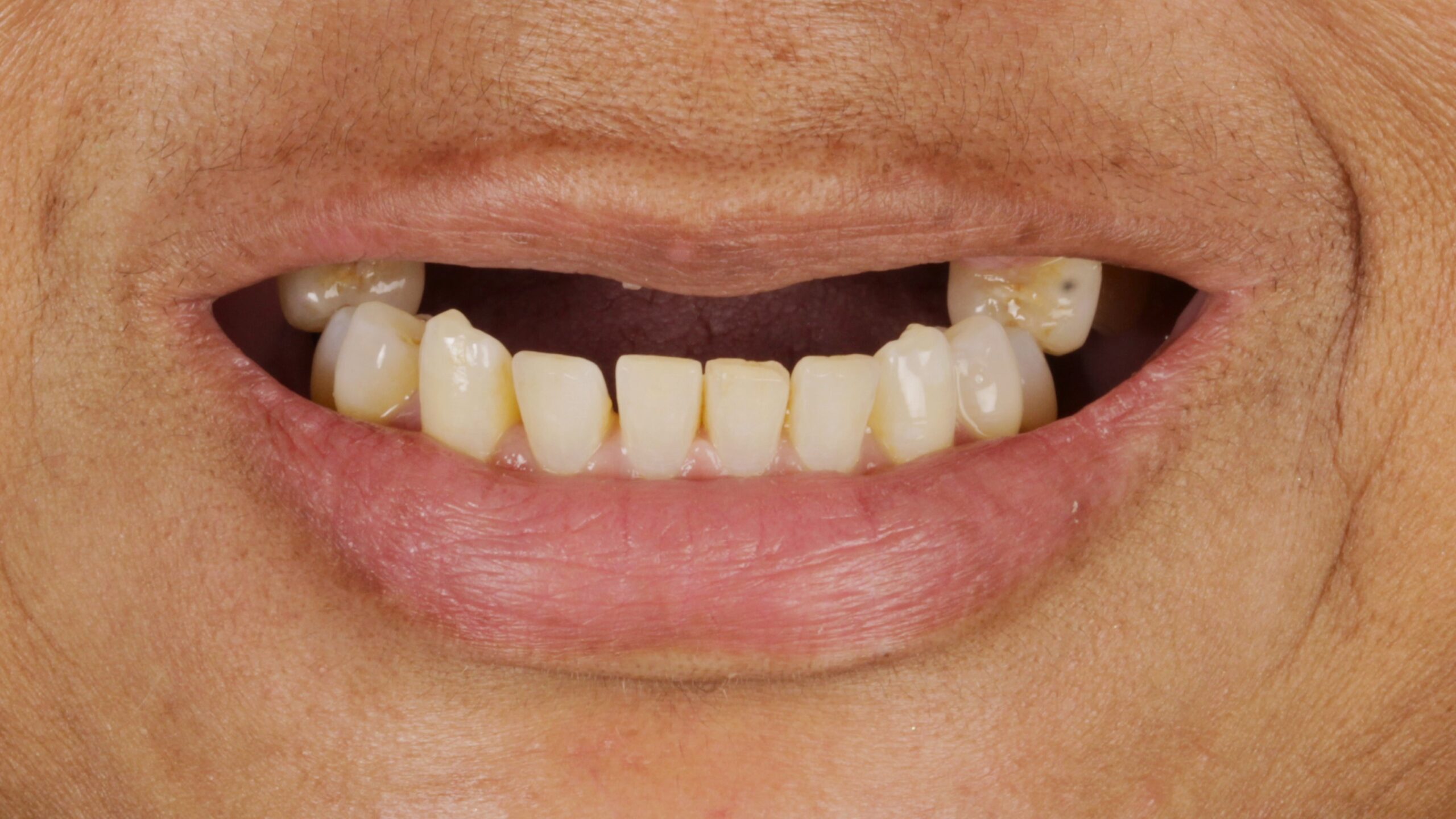 Before: double arch case 13