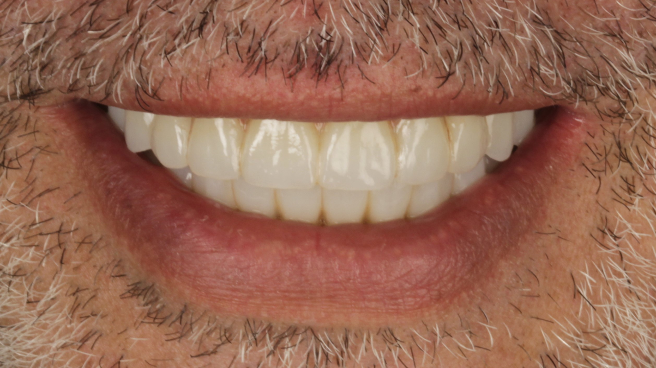 After: double arch case 14
