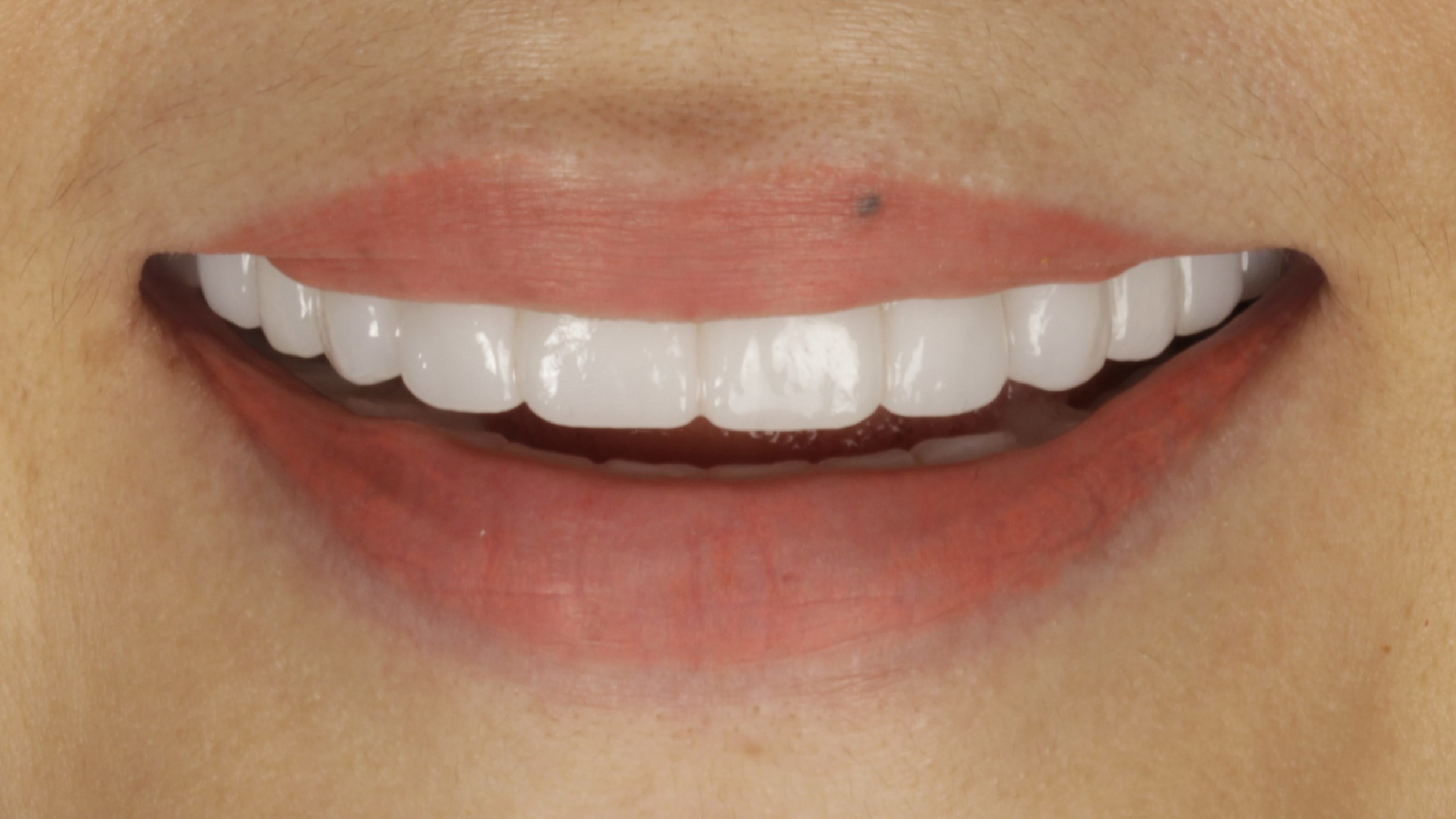 After: double arch case 2