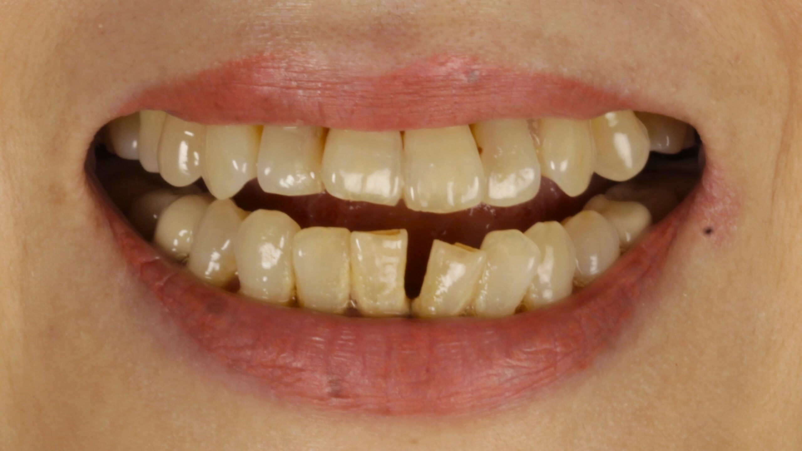 Before: double arch case 2