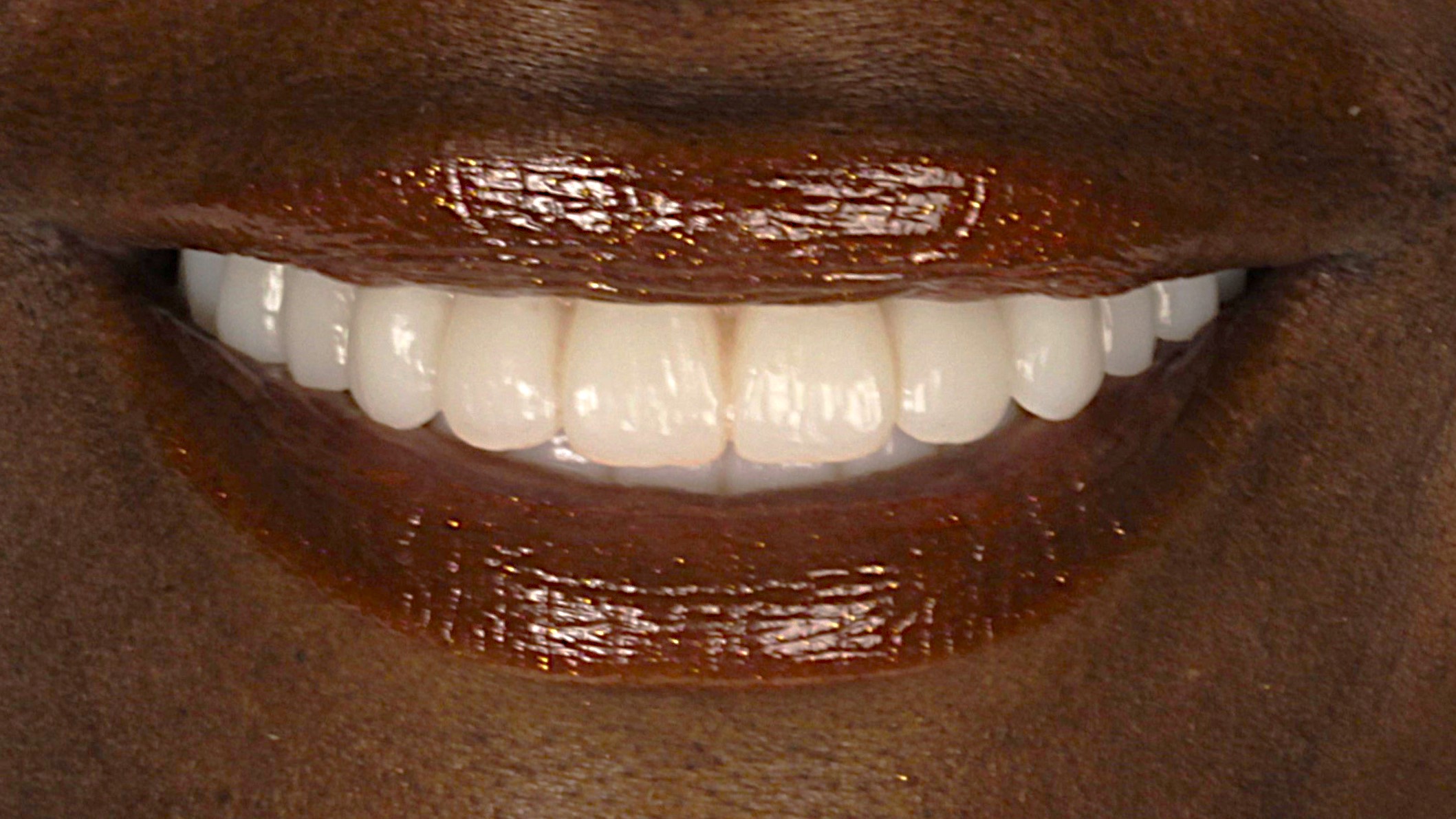 After: double arch case 4