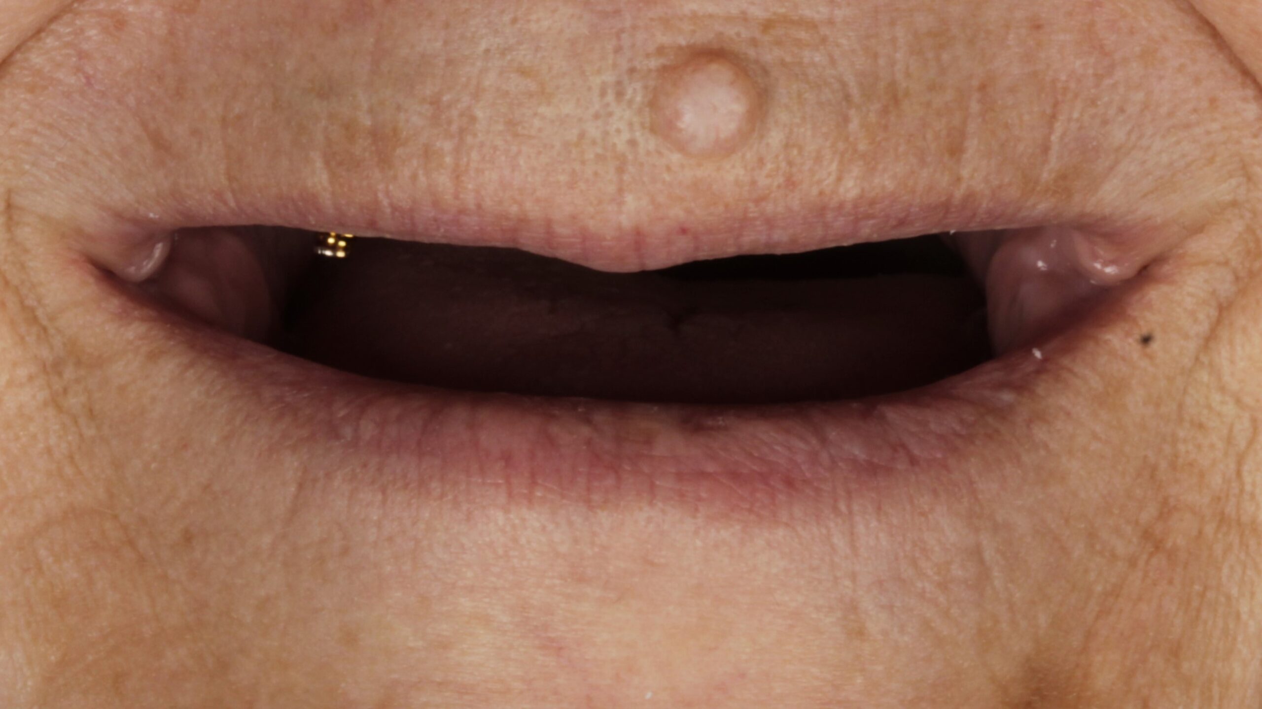 Before: double arch case 5