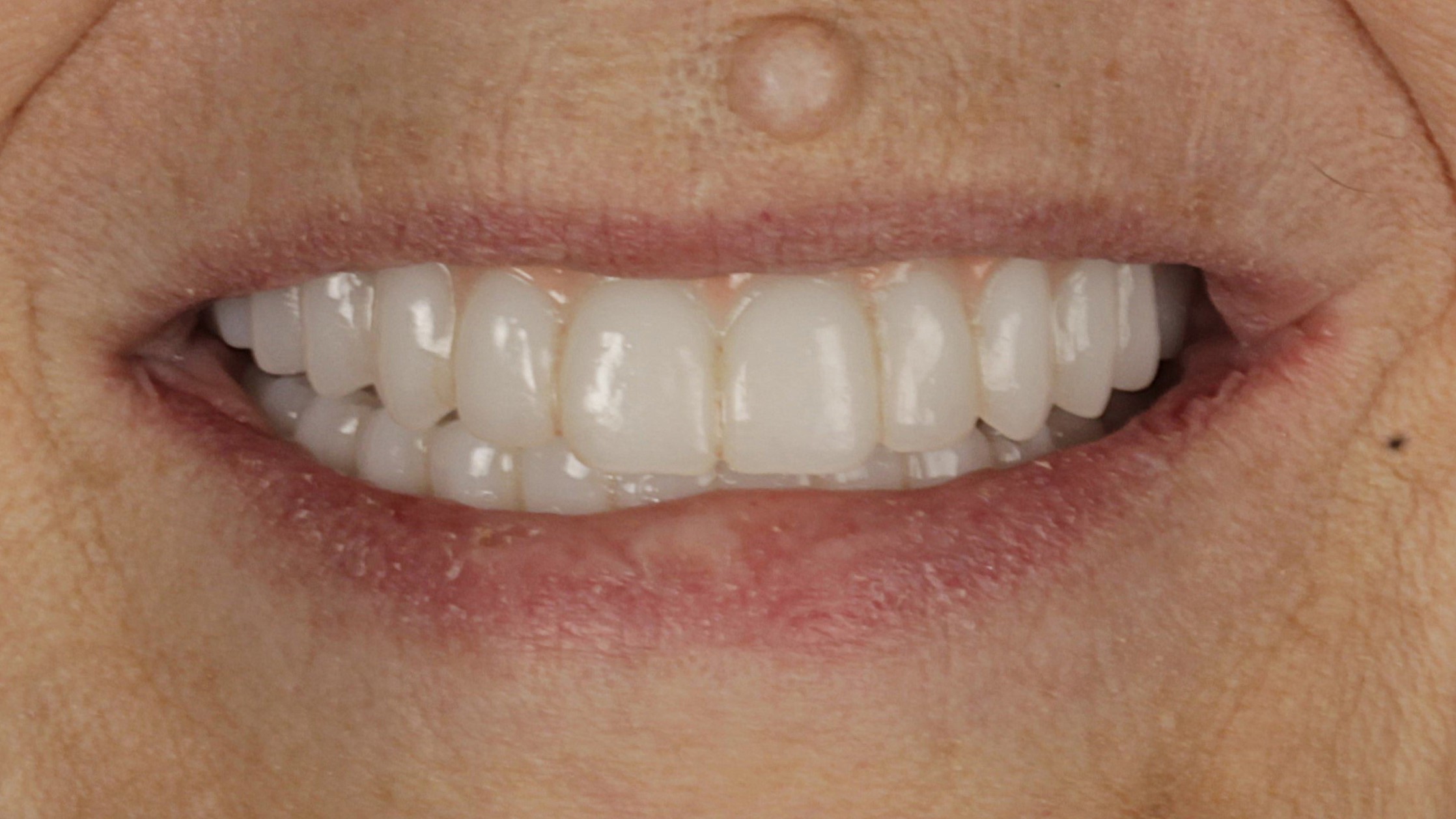 After: double arch case 5