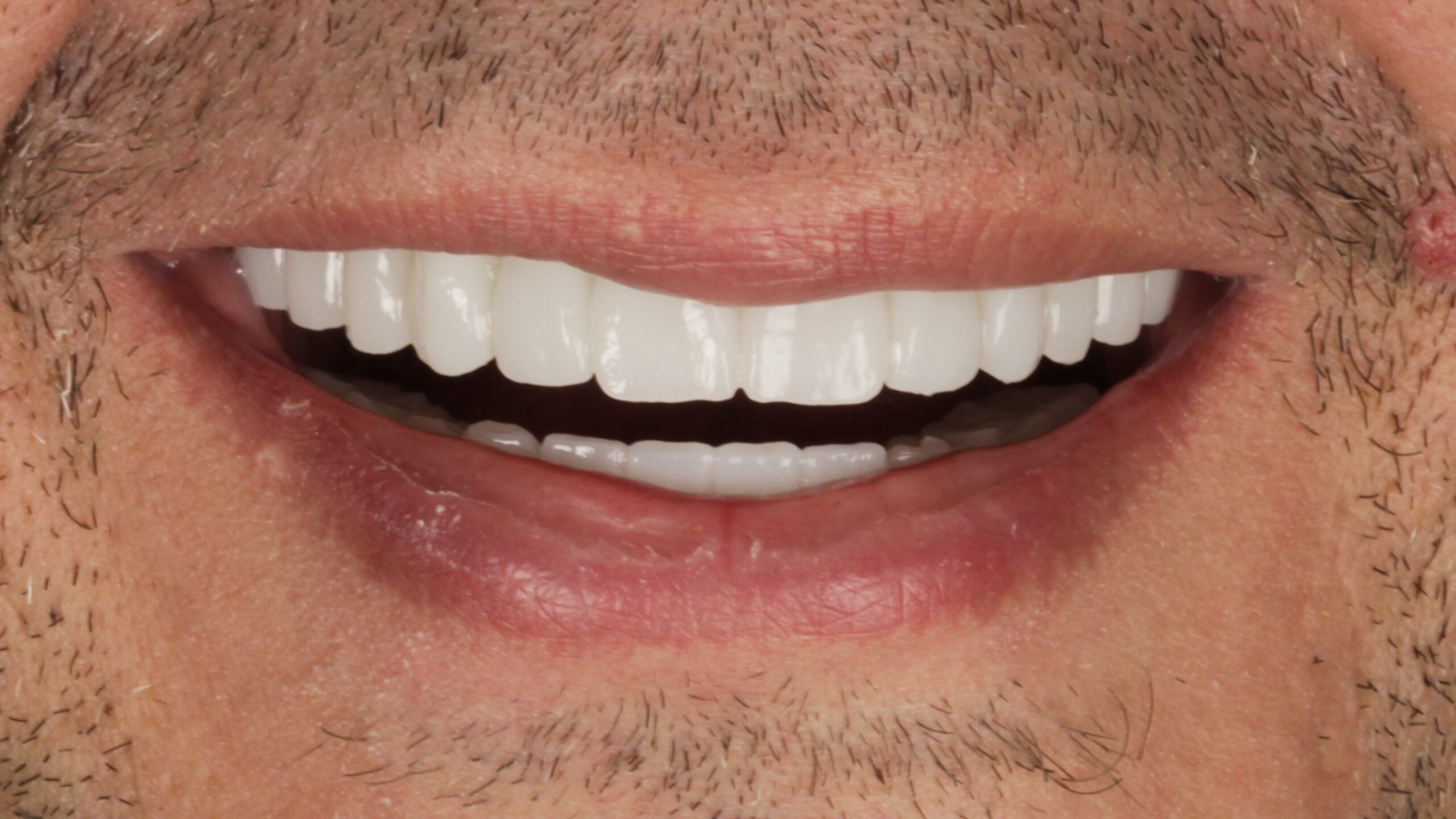 After: double arch case 6