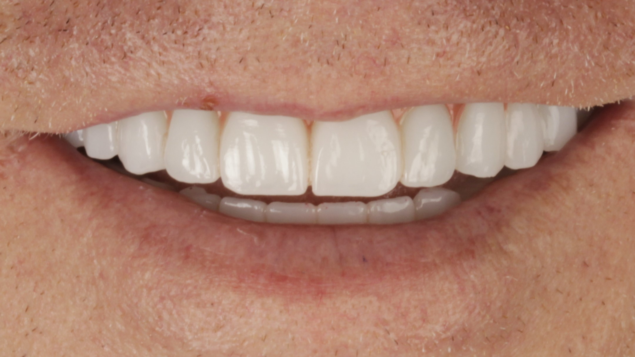 After: double arch case 8