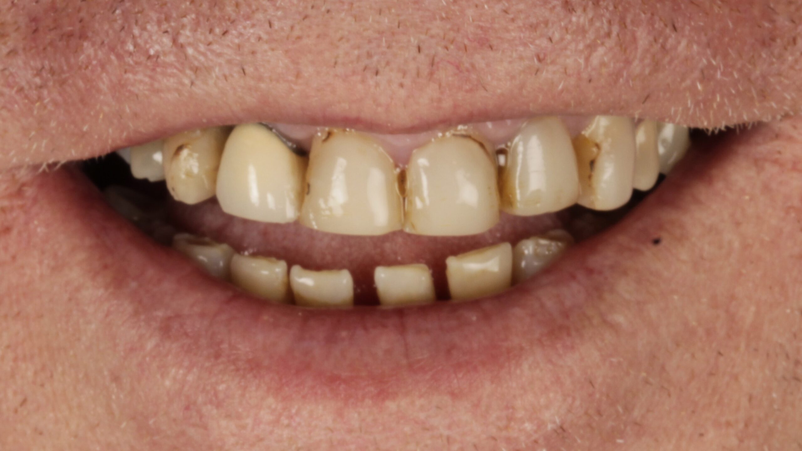 Before: double arch case 8