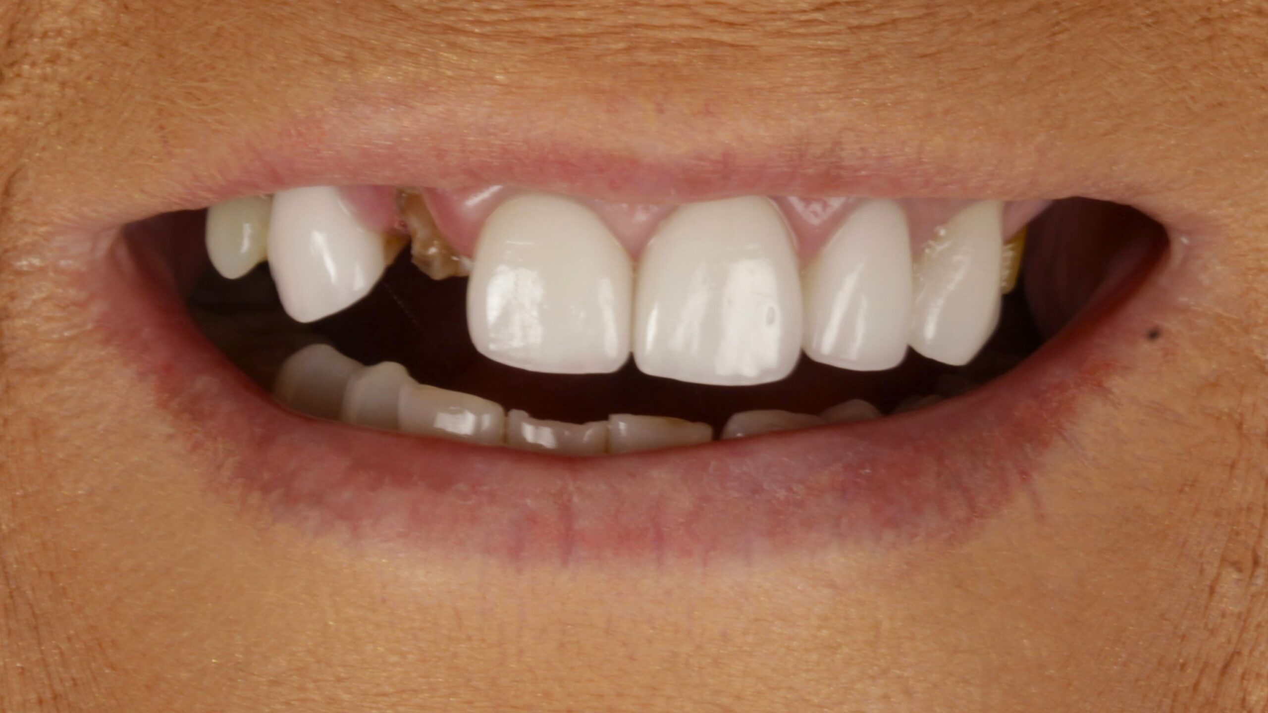 Before: double arch case 7