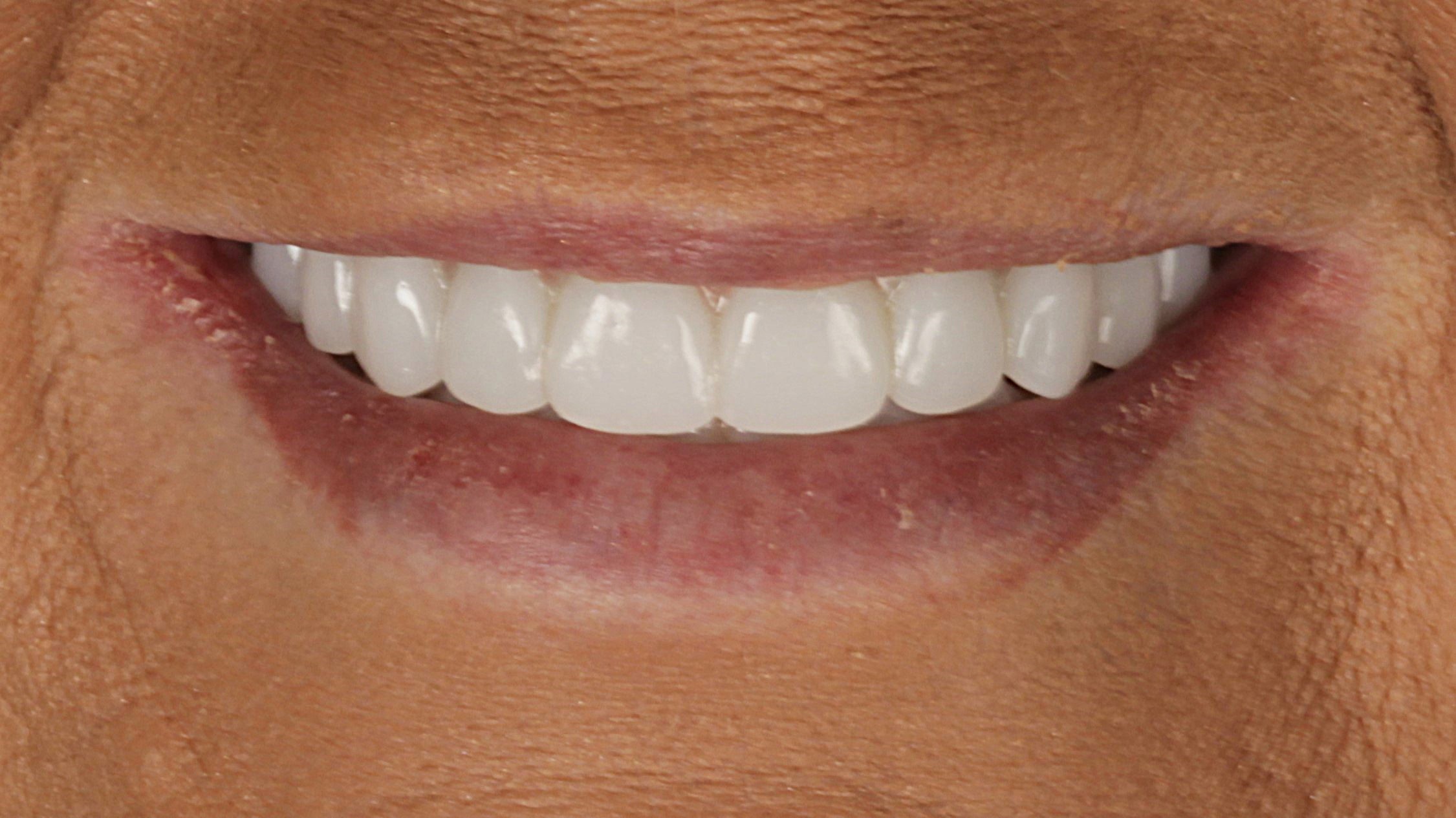 After: double arch case 7