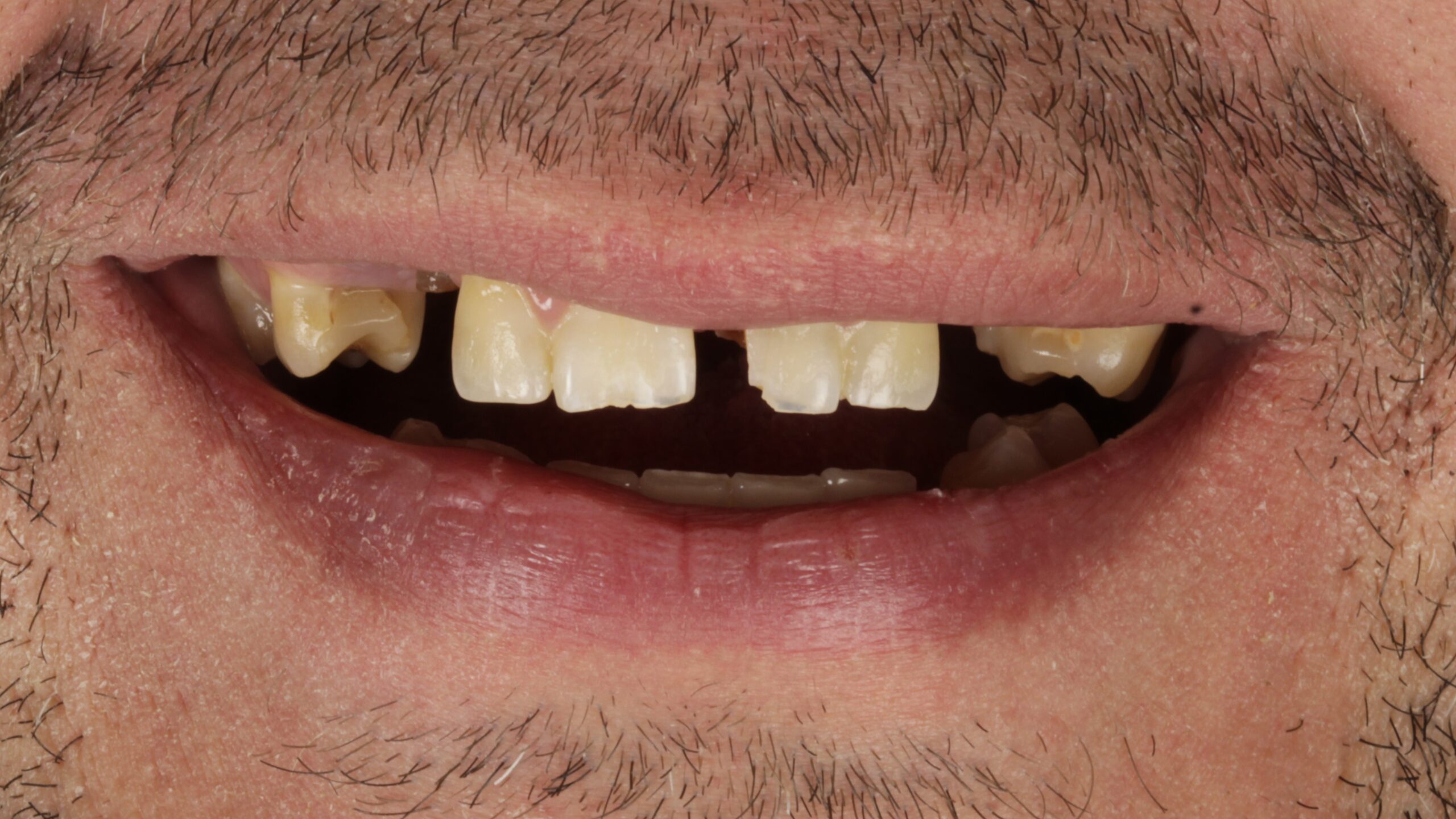 Before: double arch case 6