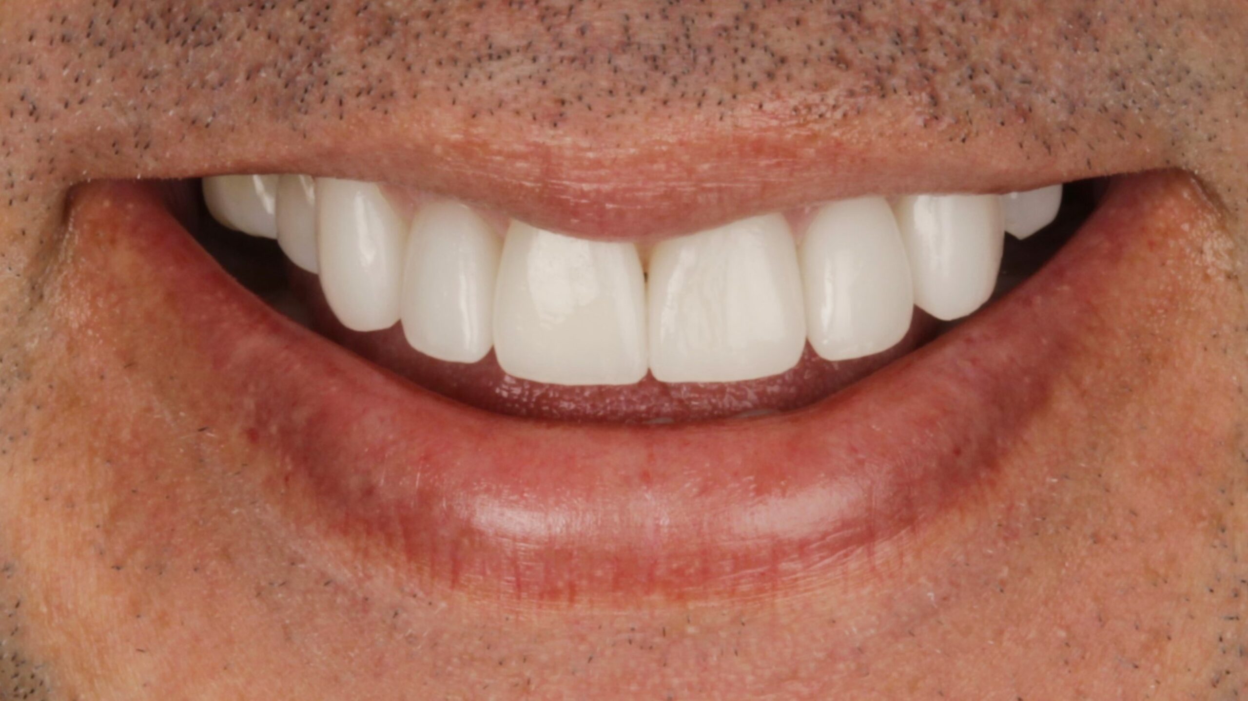 After: porcelain veneers case 4