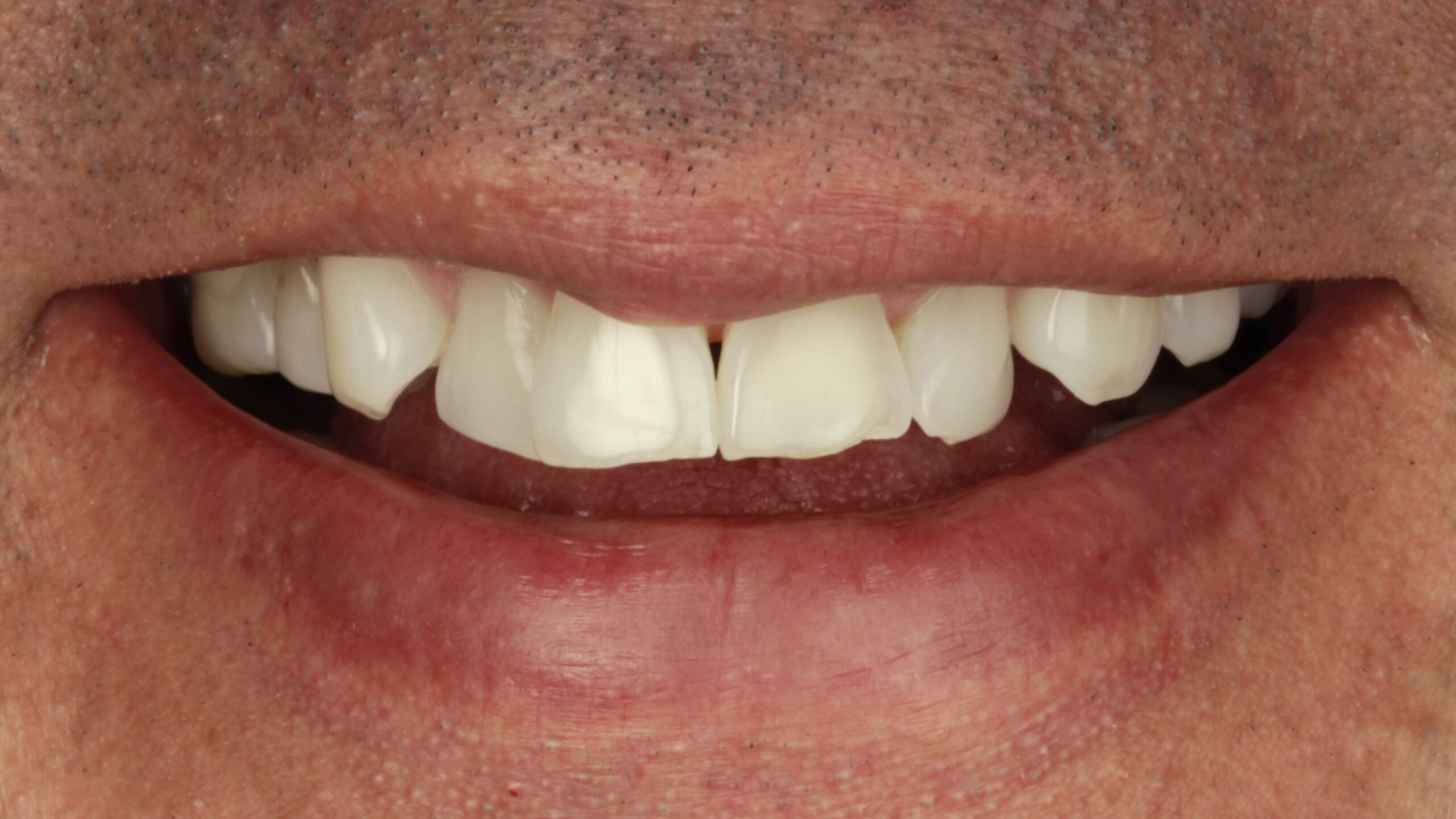 Before: porcelain veneers case 4