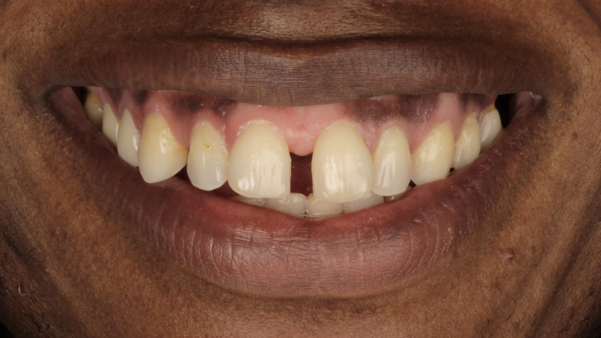 Before: porcelain veneers case 5