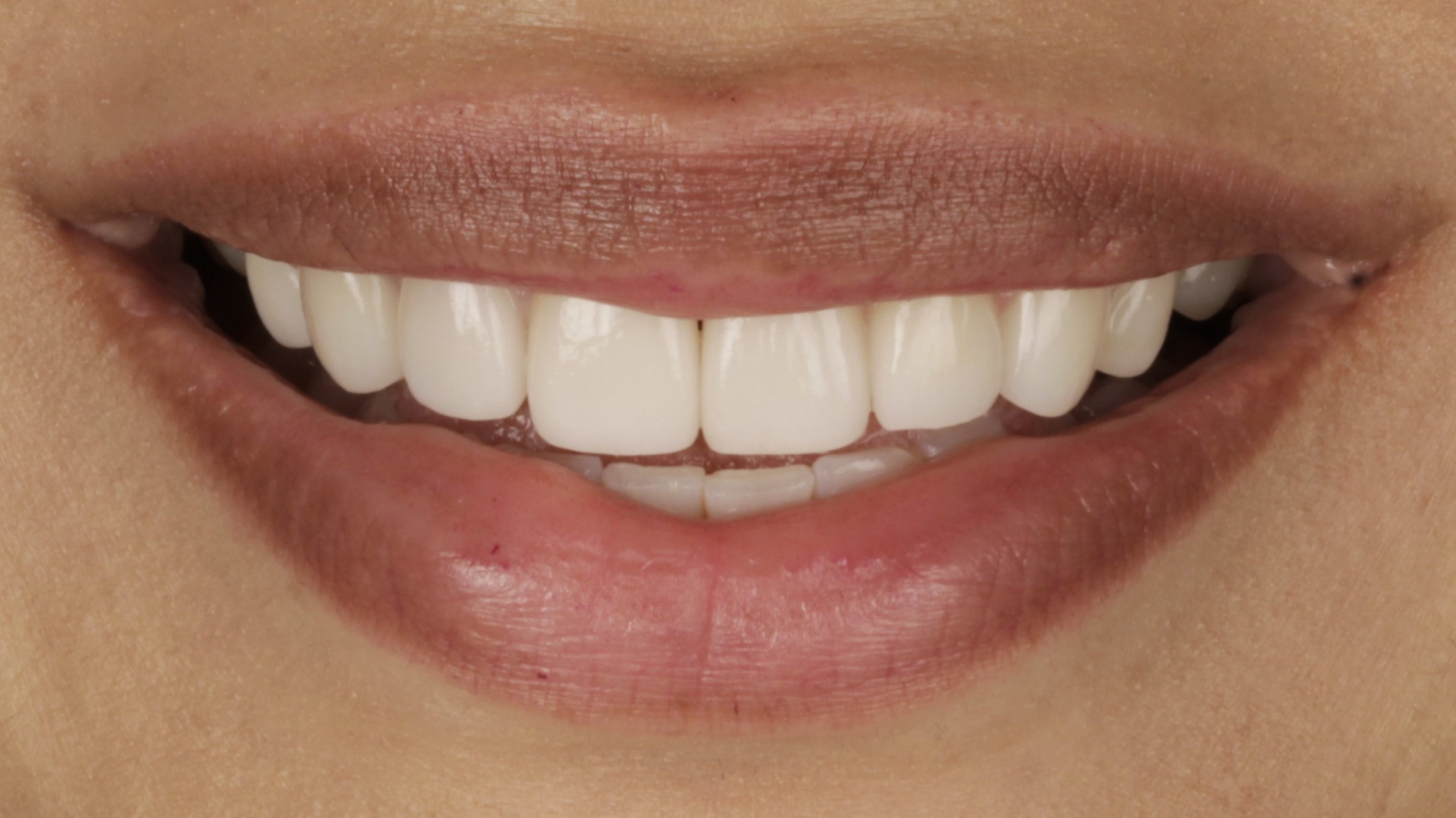 After: porcelain veneers case 6