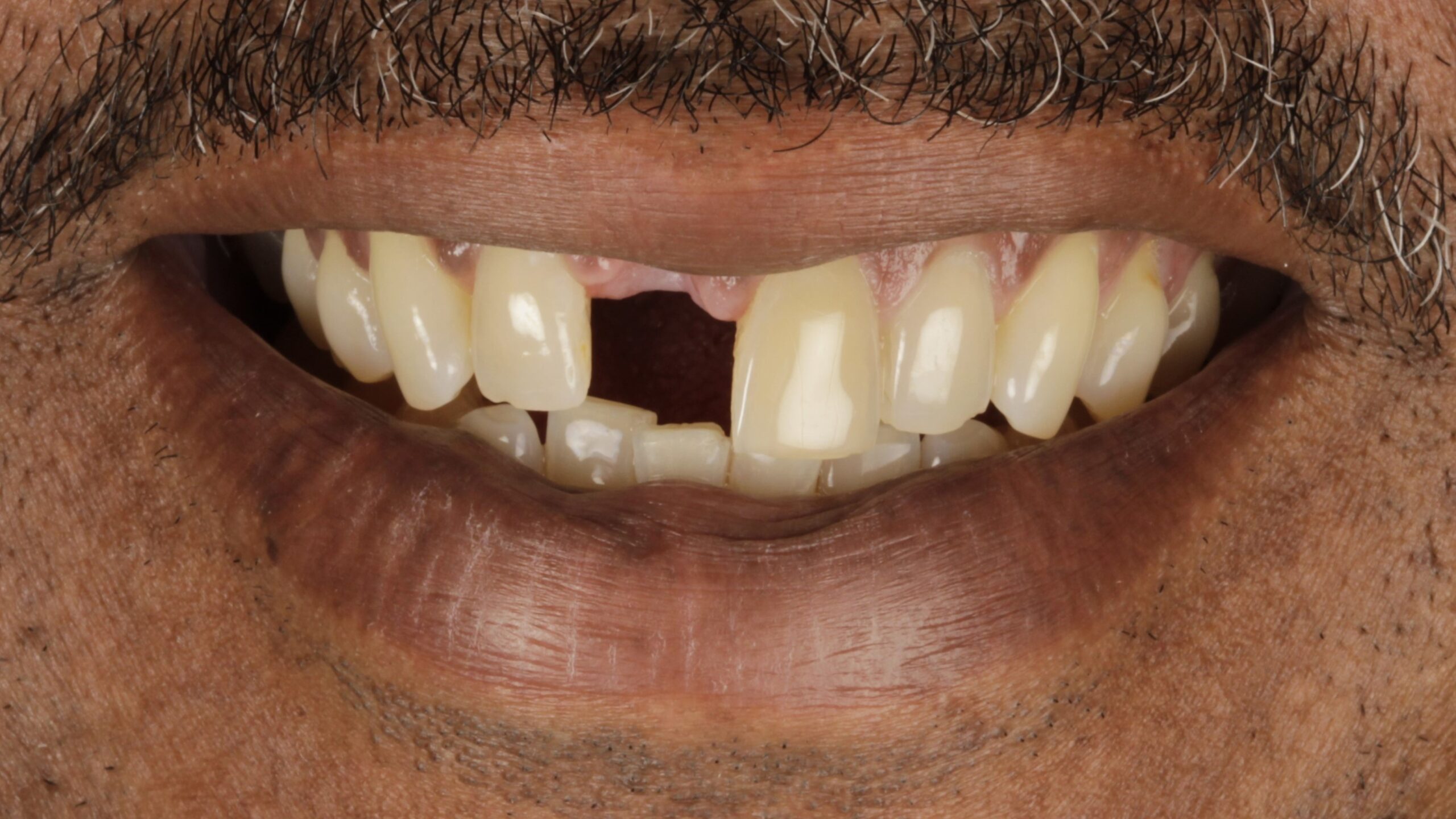 Before: veneers + implants case 3
