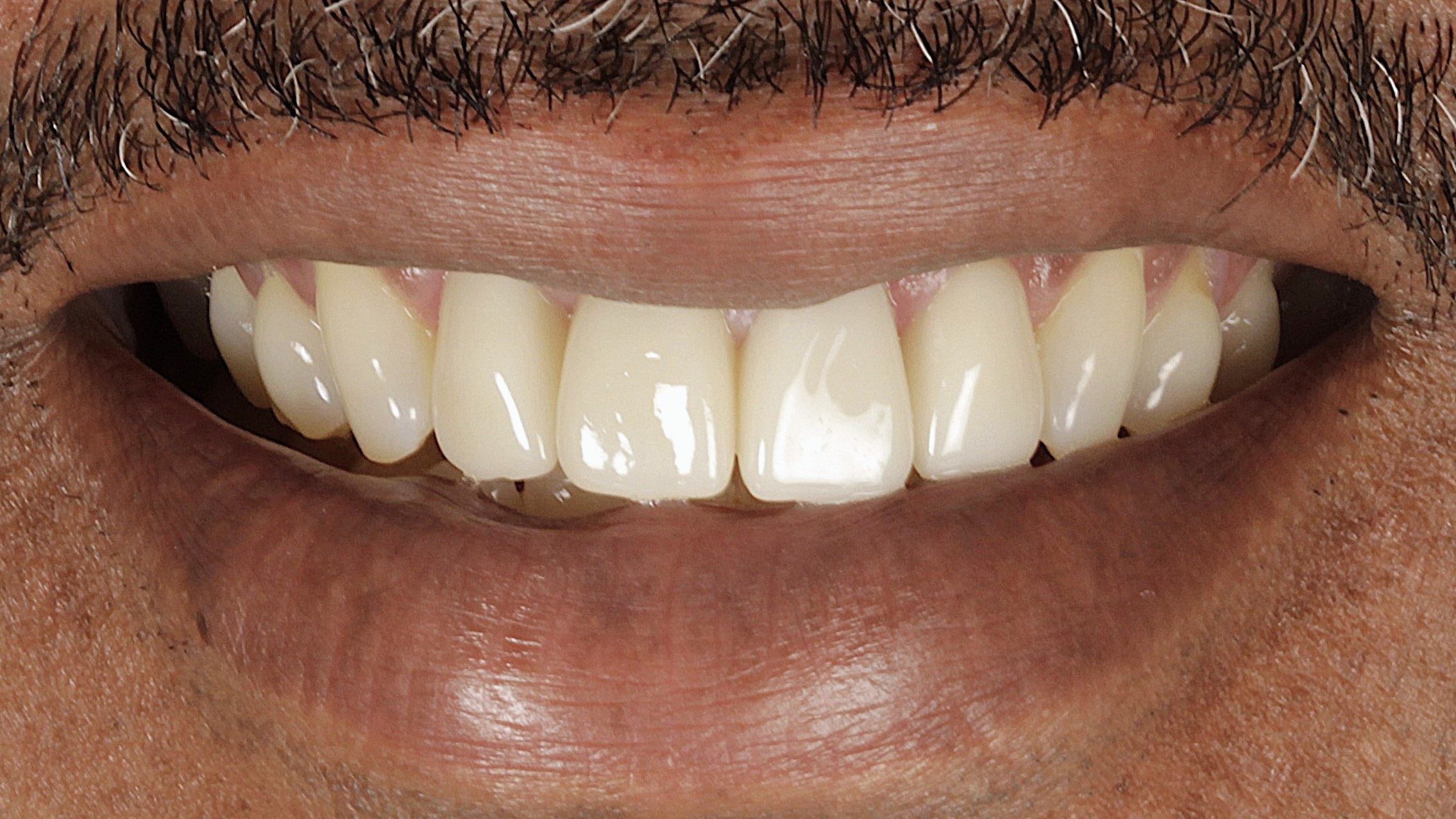 After: veneers + implants case 3