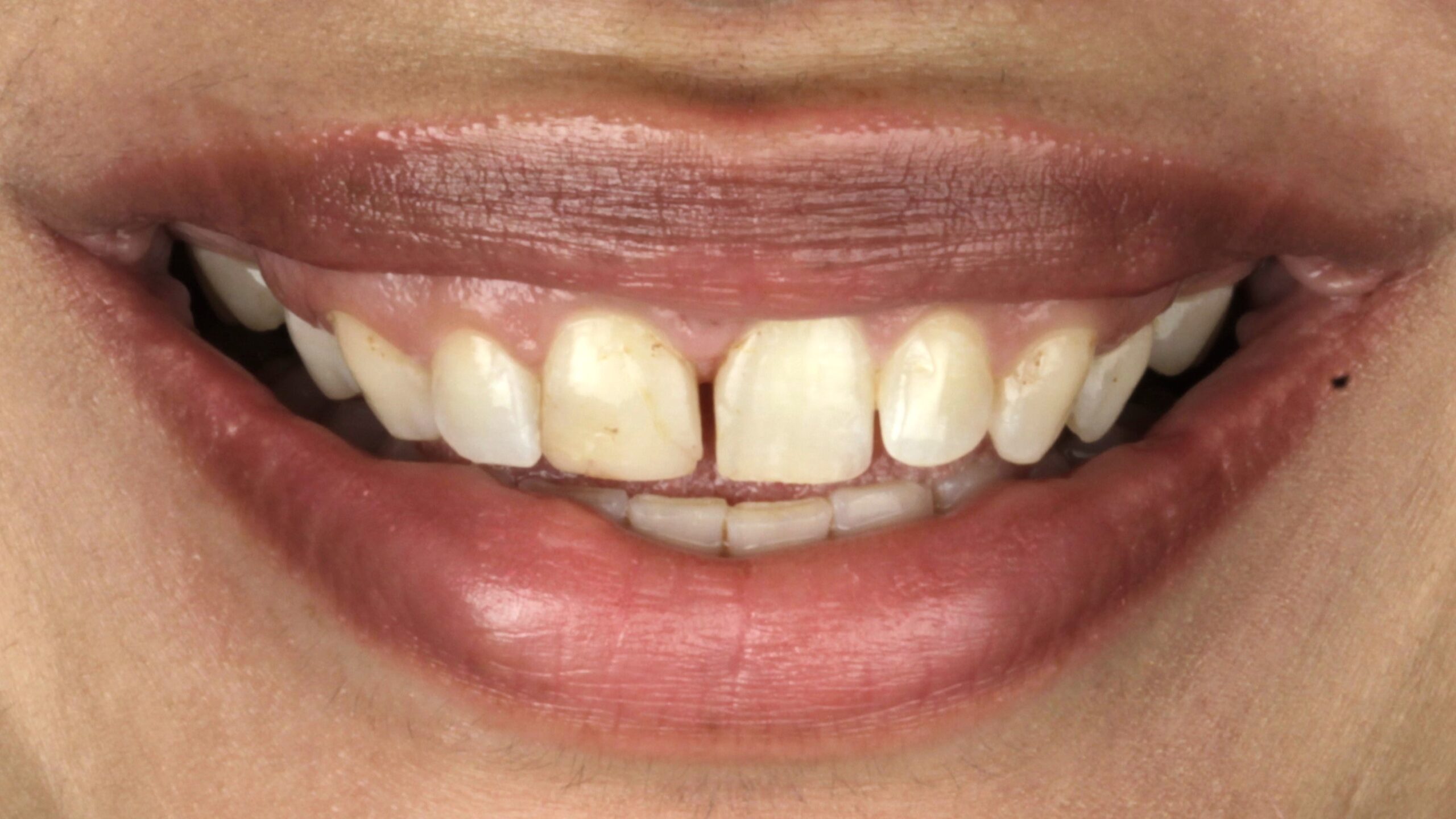 Before: porcelain veneers case 6