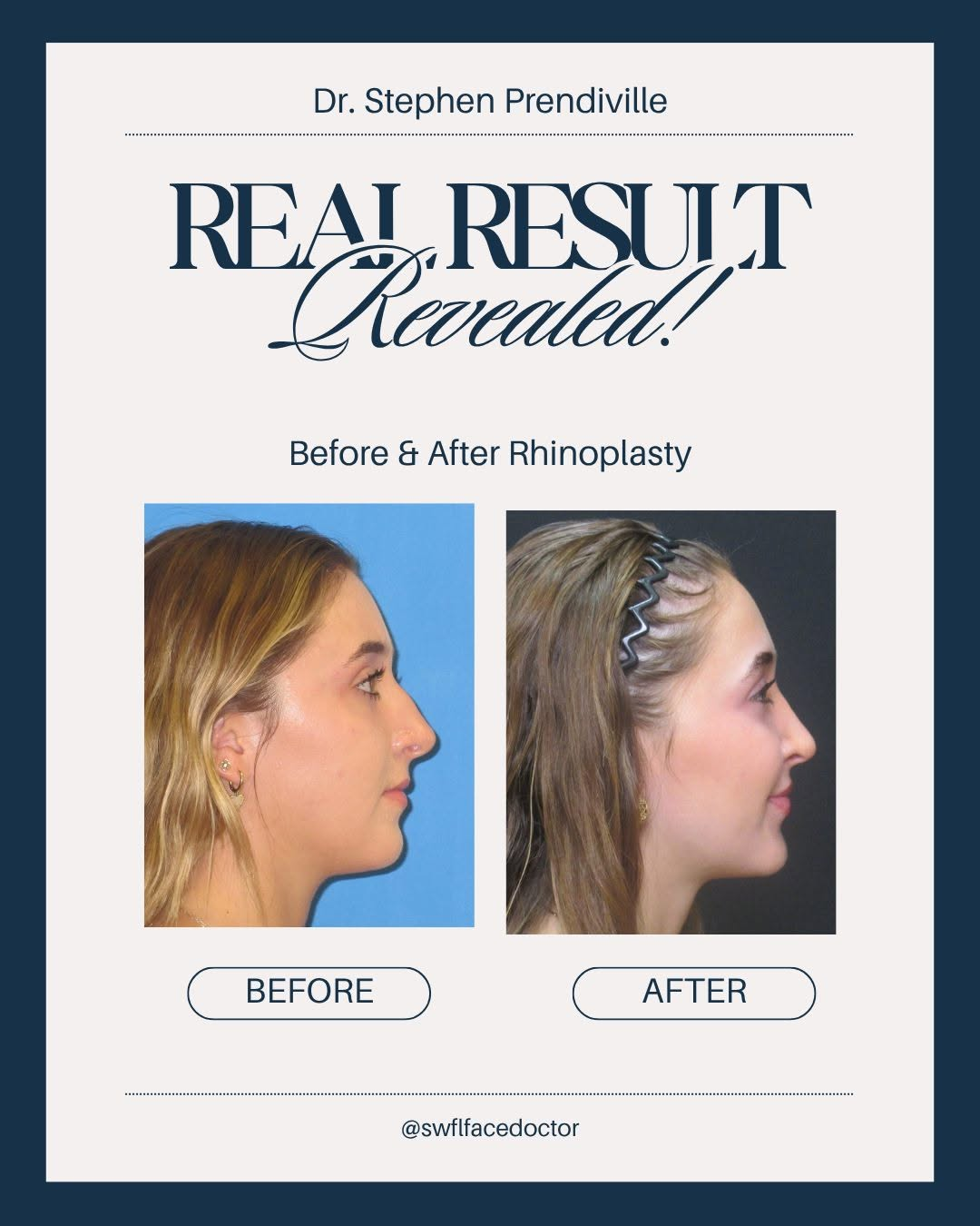 real result rhinoplasty before and after dr prendiville