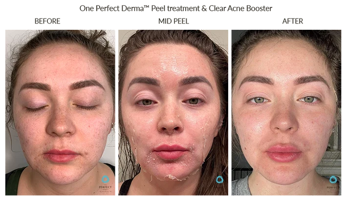 Three photographs of the same person before a Perfect Derma peel, during peeling, and afterwards.