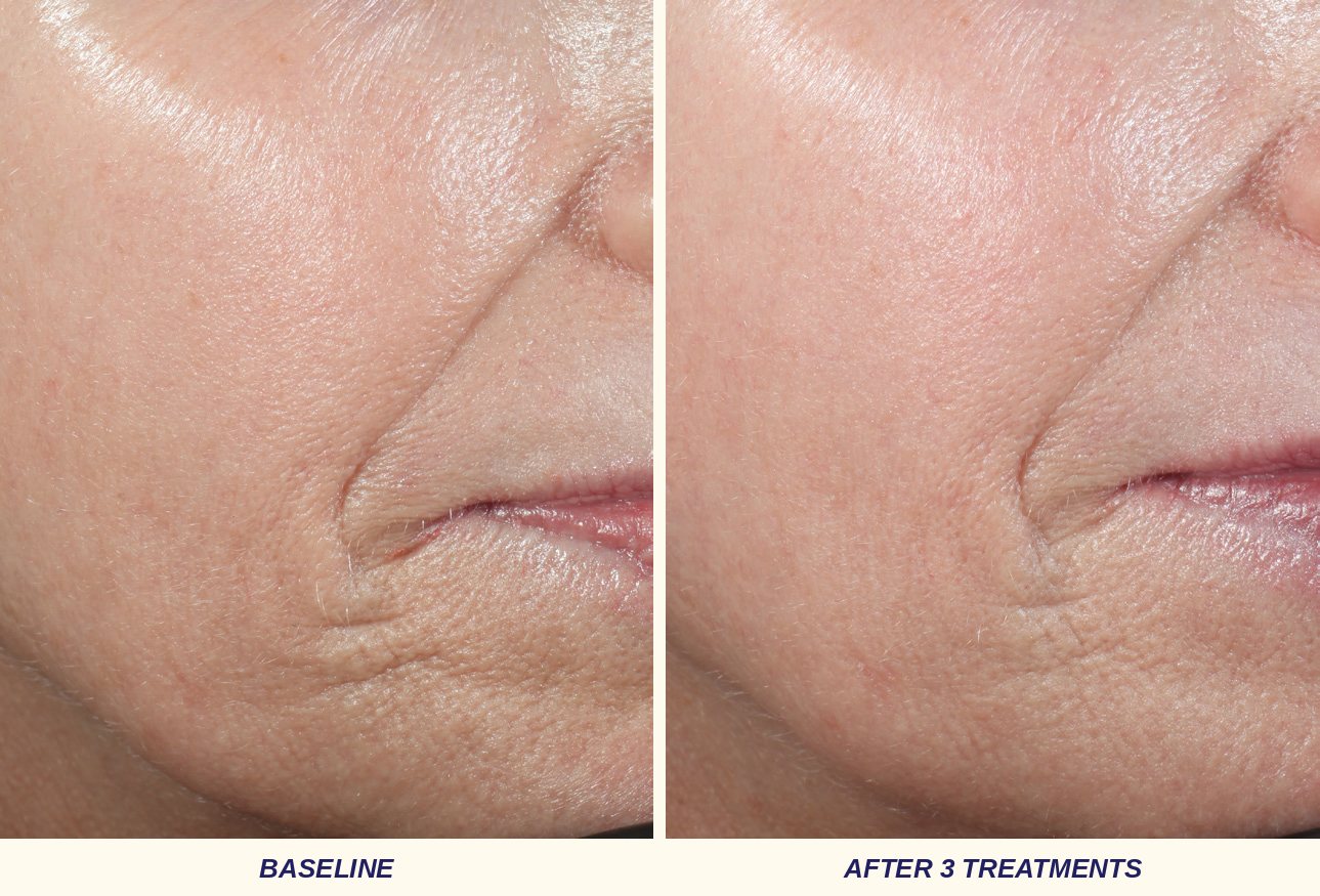 Side-by-side close-up of the same cheek and smile line at baseline and after three D·E·J BioStim treatments.