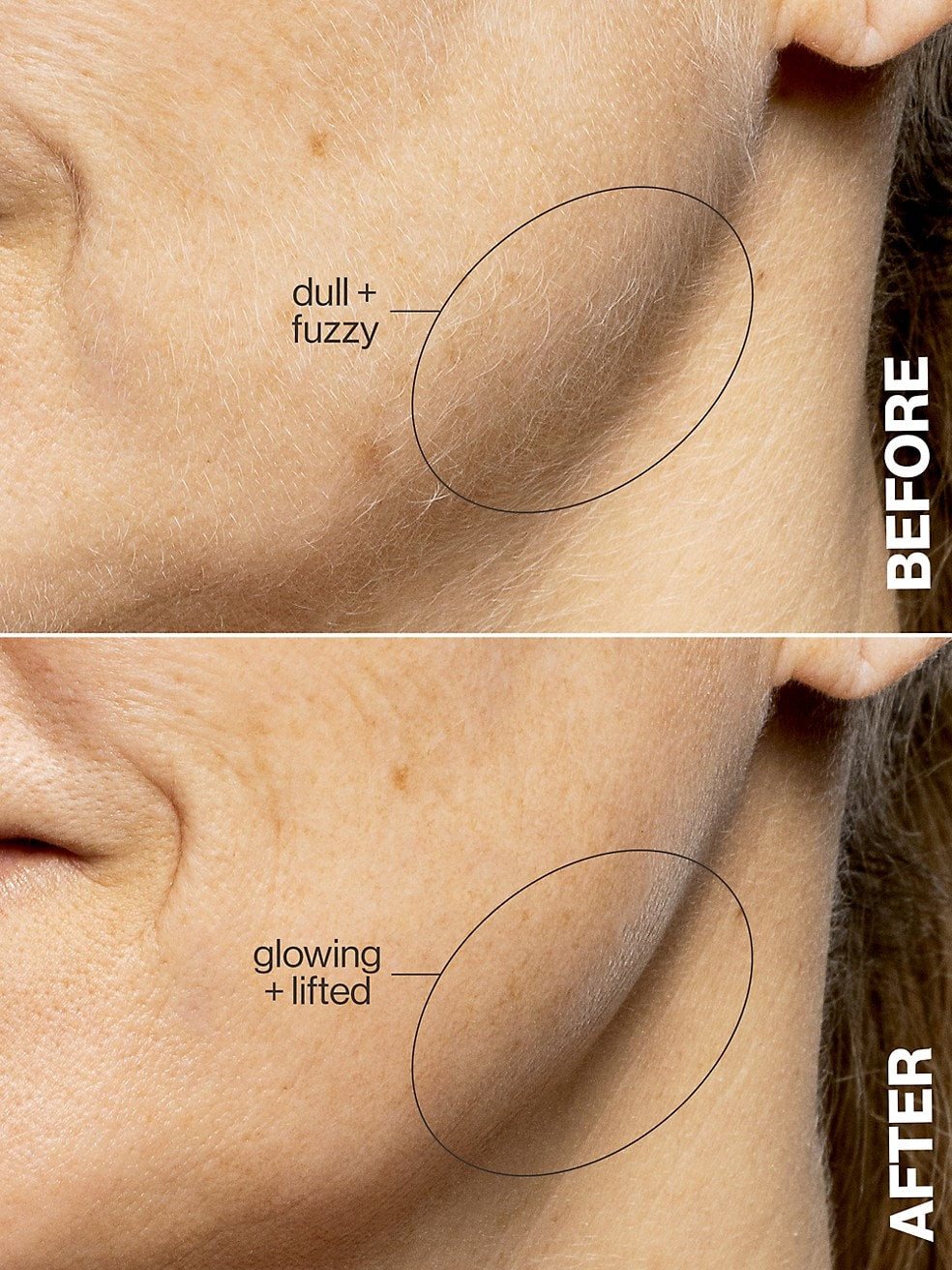 Close-up of the same cheek before and after dermaplaning, with fine facial hair visible before and removed after.