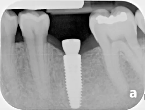 Dental X-ray of a dental implant in the upper jaw