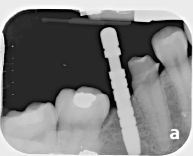 Dental X-ray of an implant beside natural teeth