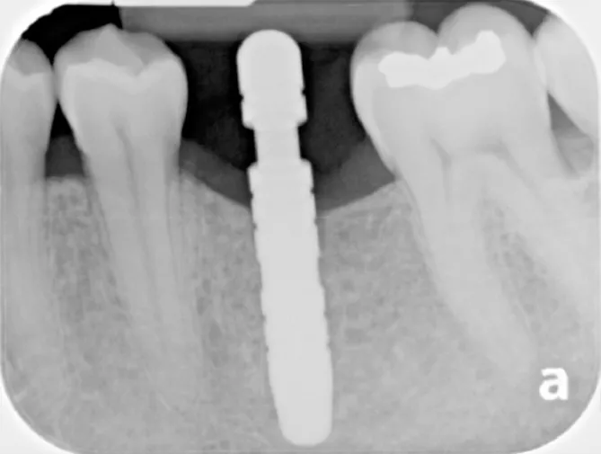 Dental X-ray showing an implant and crown between natural teeth