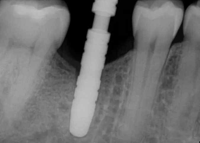 Dental X-ray of an implant integrated with the surrounding bone