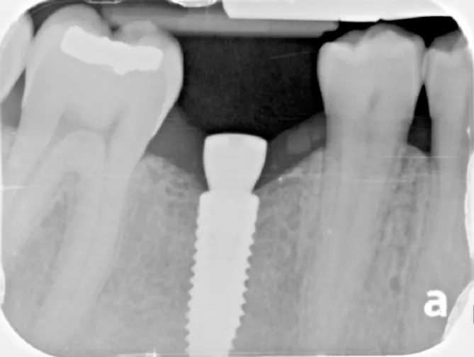 Dental X-ray of a placed dental implant