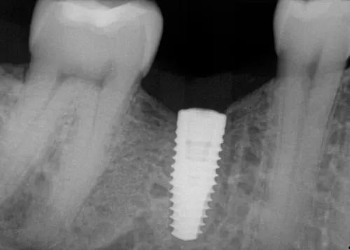 Dental X-ray of a restored dental implant