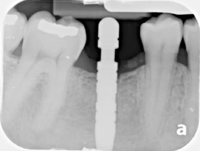 Dental X-ray of a single tooth implant with a crown