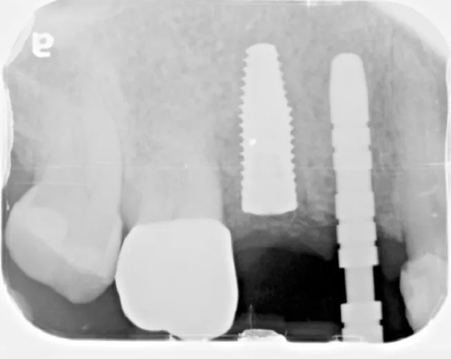 Dental X-ray showing two implants supporting a restoration