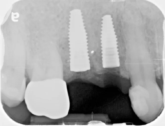 Dental X-ray of an implant-supported restoration in the upper jaw